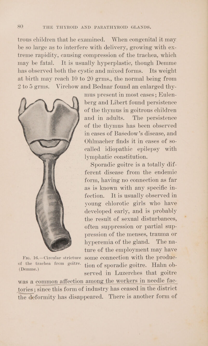 trous children that he examined. When congenital it may be so large as to interfere with delivery, growing with ex- treme rapidity, causing compression of the trachea, which may be fatal. It is usually hyperplastic, though Demme has observed both the cystic and mixed forms. Its weight at birth may reach 10 to 20 grms., the normal being from 2to5grms. Virchow and Bednar found an enlarged thy- mus present in most cases; Hulen- berg and Libert found persistence of the thymus in goitrous children and in adults. The persistence of the thymus has been observed in cases of Basedow’s disease, and Ohlmacher finds it in cases of so- ealled idiopathic epilepsy with lymphatic constitution. Sporadic goitre is a totally dif- ferent disease from the endemic form, having no connection as far as is known with any specific in- fection. It is usually observed in young chlorotic girls who have developed early, and is probably the result of sexual disturbances, often suppression or partial sup- pression of the menses, trauma or hyperemia of the gland. The na- ture of the employment may have Fic. 16.—Circular stricture some connection with the produc- rae eae from goitre. tion of sporadic goitre. Hahn ob- served in Luzerches that goitre was a common affection among | the workers in needle fac- tories ; since this form of industry has ceased in ‘the district the deformity has disappeared. There is another form of