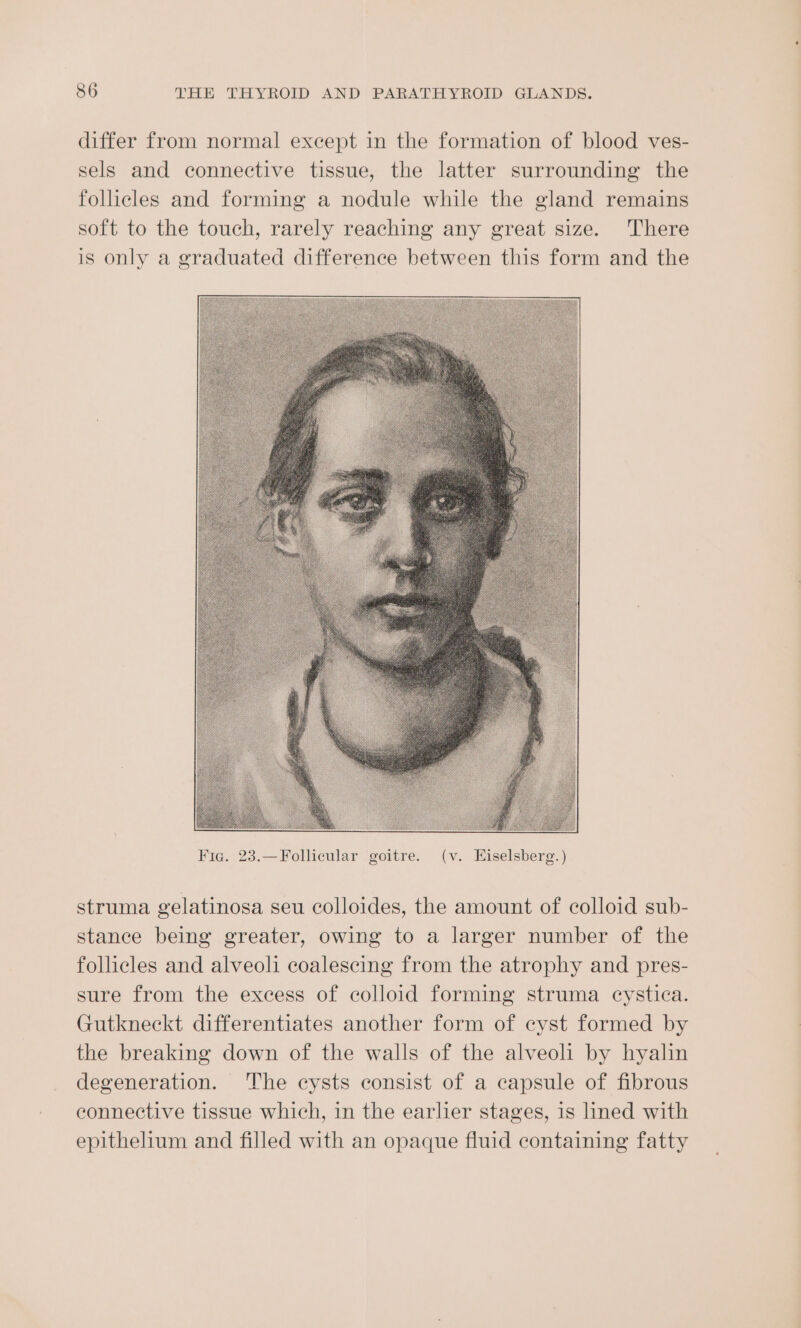 differ from normal except in the formation of blood ves- sels and connective tissue, the latter surrounding the follicles and forming a nodule while the gland remains soft to the touch, rarely reaching any great size. There is only a graduated difference between this form and the struma gelatinosa seu colloides, the amount of colloid sub- stance being greater, owing to a larger number of the follicles and alveoli coalescing from the atrophy and pres- sure from the excess of colloid forming struma cystica. Gutkneckt differentiates another form of cyst formed by the breaking down of the walls of the alveoli by hyalin degeneration. The cysts consist of a capsule of fibrous connective tissue which, in the earlier stages, 1s lined with epithelium and filled with an opaque fluid containing fatty