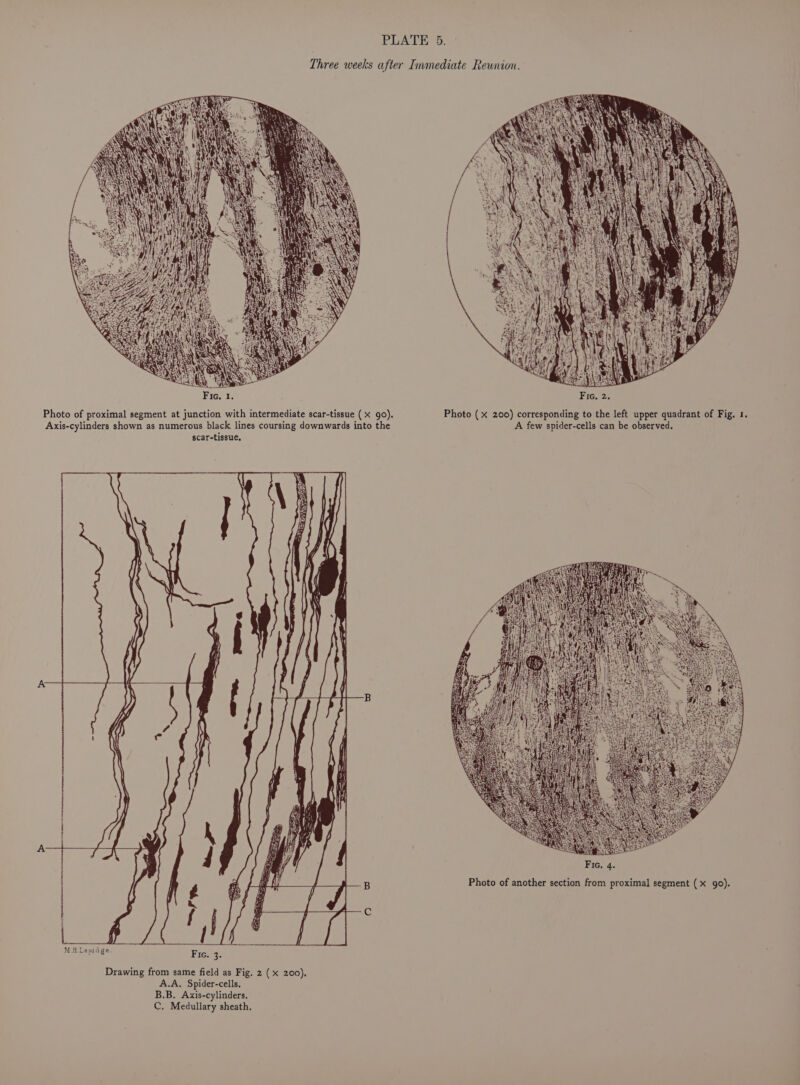 Drawing from same field as Fig. 2 ( x 200). A.A. Spider-cells. B.B. Axis-cylinders. C. Medullary sheath. Photo of another section from proximal segment (x 90).