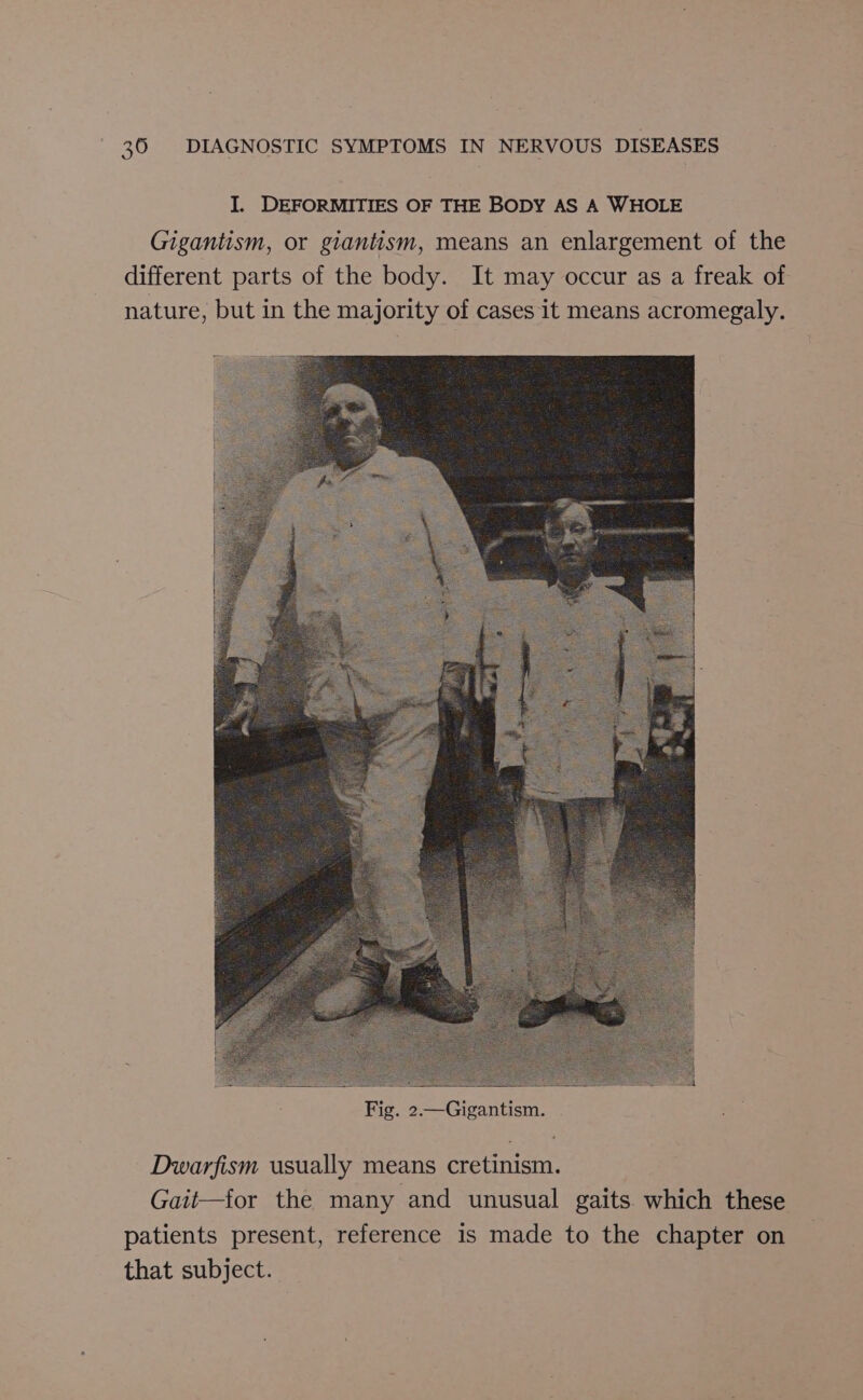 J. DEFORMITIES OF THE BODY AS A WHOLE Gigantism, or giantism, means an enlargement of the different parts of the body. It may occur as a freak of nature, but in the majority of cases it means acromegaly. Dwarfism usually means cretinism. Gait—for the many and unusual gaits. which these patients present, reference is made to the chapter on that subject.