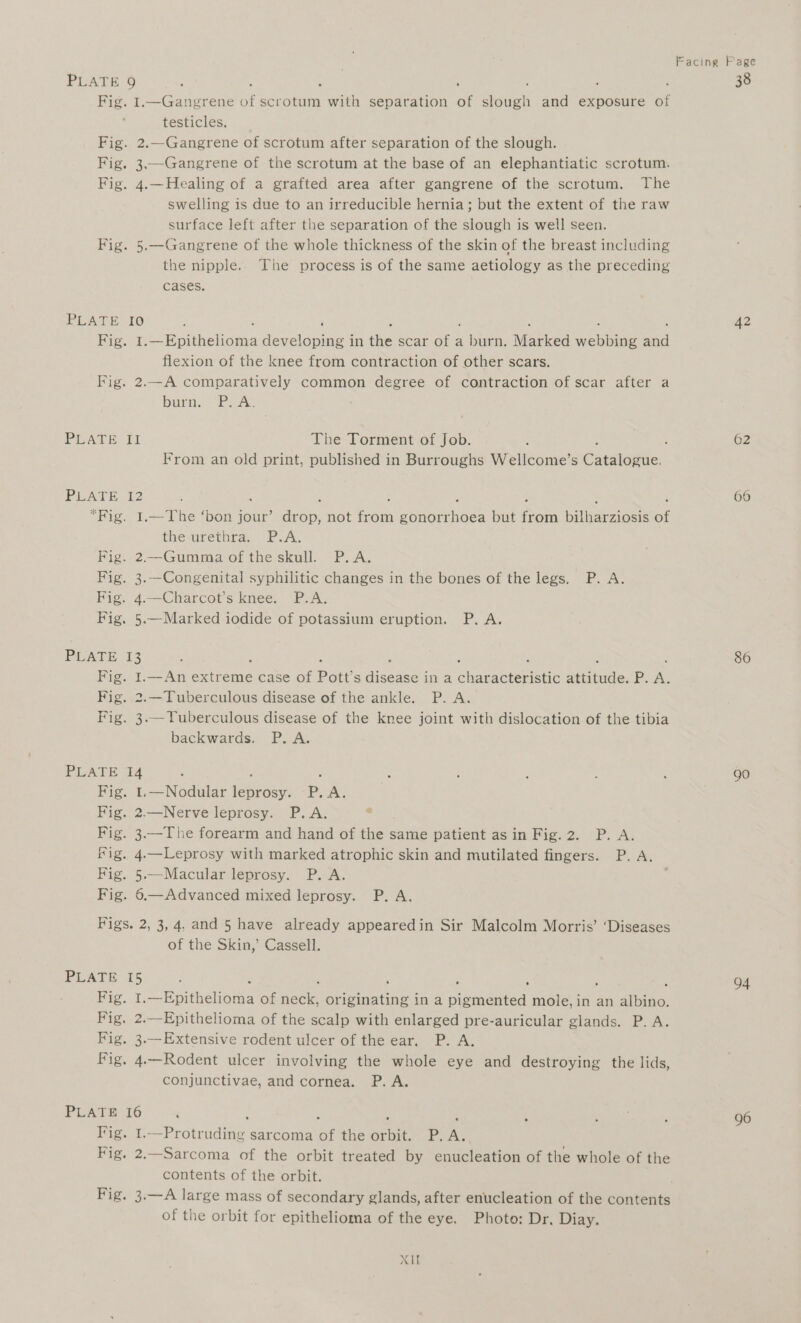 ; Facing Page PLATE 9 38 Fig. I.—Gangrene Ee scrotum rite separation of eit and exposure 6 testicles. Fig. 2.—Gangrene of scrotum after separation of the slough. Fig. 3,—Gangrene of the scrotum at the base of an elephantiatic scrotum. Fig. 4.—Healing of a grafted area after gangrene of the scrotum. The swelling is due to an irreducible hernia; but the extent of the raw surface left after the separation of the slough is well seen. Fig. 5.—-Gangrene of the whole thickness of the skin of the breast including the nipple. The process is of the same aetiology as the preceding cases. PLATE I0 ; 42 igo rts be Stihl depelsninie’ in the scar ore a burn, Marked er ee ie flexion of the knee from contraction of other scars. Fig. 2,—A comparatively common degree of contraction of scar after a burn. Ps2Ay PLAGE Tt The Torment of Job. . : 62 From an old print, published in Burroughs Wellcome’s Caratagtie PLATE 12 ‘ 66 “Fig. I.—The ‘bon jour’ anon not a enpeeiees but aa baieaineis of the urethra. P.A. Fig. 2.—Gumma of the skull. P.A. Fig. 3.—Congenital syphilitic changes in the bones of the legs. P. A. Fig. 4.—Charcot’s knee. P.A. Fig. 5.—Marked iodide of potassium eruption. P. A. PLATE 13 : 86 Fig. 1.—An extreme case of Pott’ Ss aise noes! ee Schone seid iil, P. re Fig. 2.—Tuberculous disease of the ankle. P. A. Fig. 3.— Tuberculous disease of the knee joint with dislocation of the tibia backwards. P. A. PLATE 14 : 5 : : ; : go Fig. 1.—Nodular ieee P. A. Fig. 2.—Nerve leprosy. P.A. 2 Fig. 3.—The forearm and hand of the same patient as in Fig.2. P. A. fig. 4.—Leprosy with marked atrophic skin and mutilated fingers. P. A. Fig. 5.—Macular leprosy. P. A. Fig. 6.—Advanced mixed leprosy. P. A. Figs. 2, 3,4, and 5 have already appearedin Sir Malcolm Morris’ ‘Diseases of the Skin,’ Cassell. PLATE 15 94 Hig, 1, or Ahalone of Hea ne oes ina aireeeea mole, in an albiie: Fig. 2..-Epithelioma of the scalp with enlarged pre-auricular glands. P. A. Fig. 3.—Extensive rodent ulcer of the ear, P. A. Fig. 4.—Rodent ulcer involving the whole eye and destroying the lids, conjunctivae, and cornea. P. A. PLATE I6 ‘ : ‘ hata . 96 ie. I. SP erene sarcoma is the Aone PAs. Fig. 2.—Sarcoma of the orbit treated by enucleation of the whole of the contents of the orbit. Fig. 3.—A large mass of secondary glands, after enucleation of the contents of the orbit for epithelioma of the eye. Photo: Dr. Diay. XIf