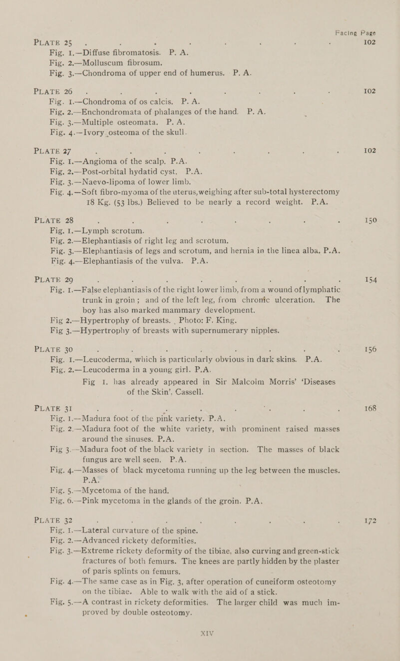 PLATE 25. : : Fig. 1.—Diffuse Abromareeis P. A. Fig. 2,—Molluscum fibrosum. Fig. 3.—Chondroma of upper end of humerus. P. A. PLATE 26 ; Fig. I. “Jeheaar oath of os Sahis POA Fig. 2.—Enchondromata of phalanges of the hand. P. A. Fig. 3.—Multiple osteomata. P. A. Fig. 4.—Ivory.osteoma of the skull. PEAT E27 Fig. I.—Angioma of ie eae P.A. Fig, 2.—Post-orbital hydatid cyst. P.A. Fig. 3.—Naevo-lipoma of lower limb. Fig. 4.—Soft fibro-myoma of the uterus, weighing after sub-total hysterectomy 18 Kg. (53 lbs.) Believed to be nearly a record weight. P.A. PLATE 28 Fig. I.—Lymph scrotum. Fig. 2.—Elephantiasis of right leg and scrotum. Fig. 3.—Elephantiasis of legs and scrotum, and hernia in the linea alba. P.A. Fig. 4.—Elephantiasis of the vulva. P.A. PLATE 29 : Fig. I1.—False ya of the right ee an, froma ts seianenene trunk in groin; and of the left leg, from chronic ulceration. The boy has also marked mammary development. Fig 2.—Hypertrophy of breasts. . Photo: F. King. Fig 3.—Hypertrophy of breasts with supernumerary nipples. PLATE 30 : , Fig. I.—Leucoderma, which is pactieueany Sieur: in dent skins. P.A. Fig. 2,—Leucoderma in a young girl. P.A. Fig I. has already appeared in Sir Malcolm Morris’ ‘Diseases of the Skin’, Cassell. PLATE 31 Fig. 1, Sig icland foot ei the ome Ree Pol. Fig. 2,—Madura foot of the white variety, with prominent raised masses around the sinuses. P.A. Fig 3.—Madura foot of the black variety in section. The masses of black fungus are wellseen, P.A. Fig. 4.—Masses of black mycetoma running up the leg between the muscles. PA. Fig. 5.—Mycetoma of the hand. Fig. 6.—Pink mycetoma in the glands of the groin. P.A. PLATE 32 ‘ Fig. 1.—Lateral curvature of the spine. Fig. 2.—Advanced rickety deformities. Fig. 3.—Extreme rickety deformity of the tibiae, also curving and green-stick fractures of both femurs. The knees are partly hidden by the plaster of paris splints on femurs. Fig. 4.—The same case as in Fig. 3, after operation of cuneiform osteotomy on the tibiae. Able to walk with the aid of a stick. Fig. 5.—A contrast in rickety deformities. The larger child was much im- proved by double osteotomy. XIV 102 102 102 154 156 168