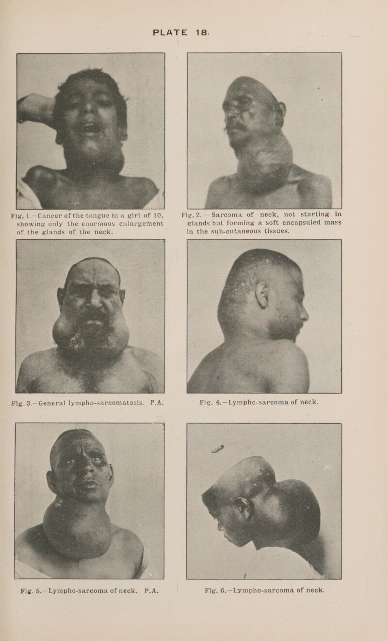 Fig. 1.—Cancer of the tongue ina girl of 10, Fig.2.— Sareoma of neck, not starting in showing only the enormous enlargement glands but forming a soft encapsuled mass of the glands of the neck. in the sub-cutaneous tissues.