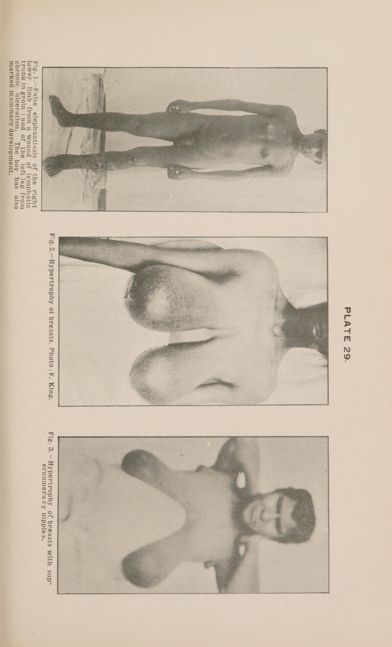 Fig. 1.—False elephantiasis of the right lower limb from a wound of lymphatic trunk in groin : and of the left leg from ehronie ulceration. The boy has also marked mammary development. Fig. 2.—Hypertrophy of breasts. Photo: F. King. sa ™ ws a 4 Fig. 3.—Hypertrophy of breasts with sup- ernumerary nipples.