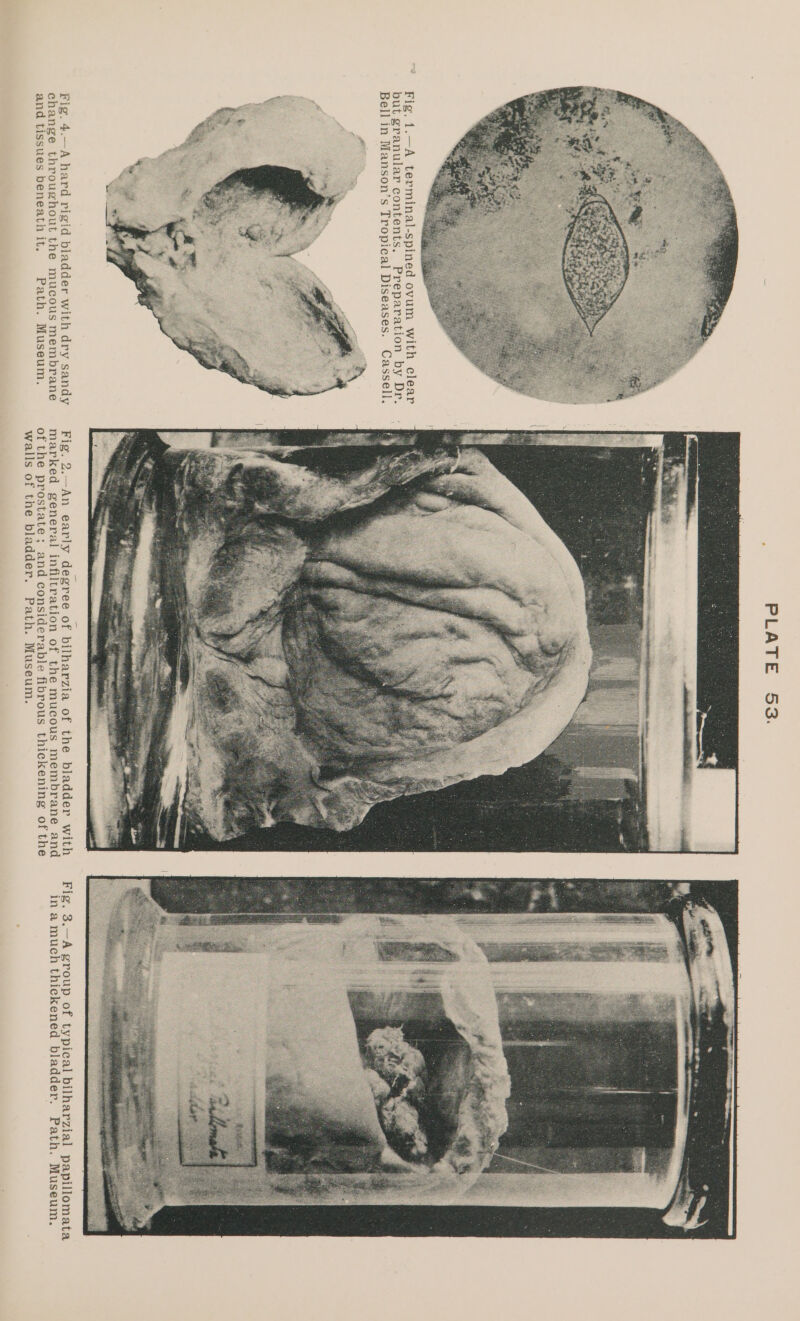 Bell in Manson’s Tropieal Diseases. Cassell. Fig. 4.—A hard rigid bladder with dry sandy Fig. 2.—An early degree of bilharzia of the bladder with Fig. 3.—A group of typical bilharzial papillomata change throughout the mucous membrane marked general infiltration of the mucous membrane and ina much thickened bladder. Path. Museum. and tissues beneath it. Path. Museum. of the prostate; and considerable fibrous thickening of the walls of the bladder. Path. Museum.