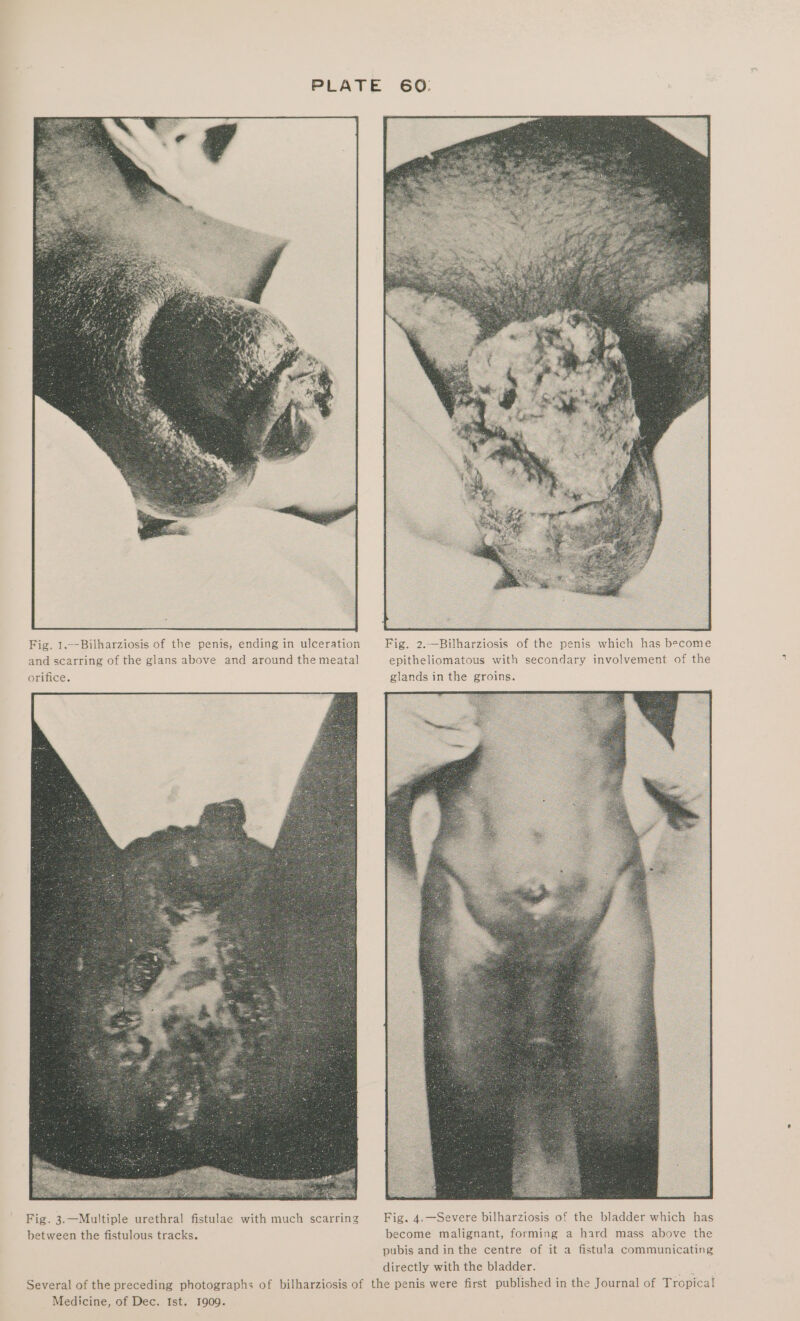 Fig, 1.--Bilharziosis of the penis, ending in ulceration Fig. 2.—Bilharziosis of the penis which has become and scarring of the glans above and around the meatal epitheliomatous with secondary involvement of the orifice. glands in the groins. Fig. 3.—Multiple urethral fistulae with much scarring Fig. 4.—Severe bilharziosis of the bladder which has between the fistulous tracks. become malignant, forming a hard mass above the pubis and in the centre of it a fistula communicating directly with the bladder. ts Several of the preceding photographs of bilharziosis of the penis were first published in the Journal of Tropical Medicine, of Dec. Ist. 1909.