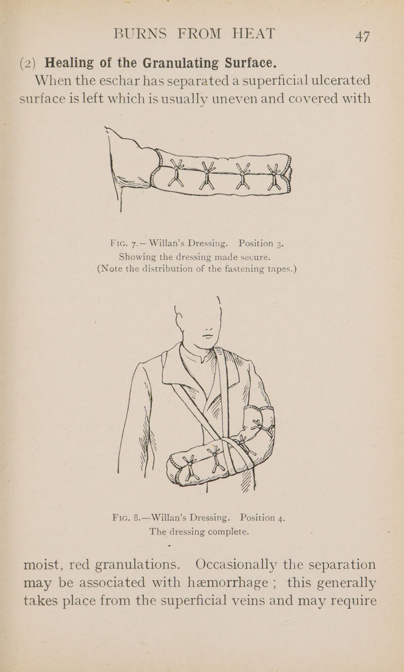 (2) Healing of the Granulating Surface. When the eschar has separated a superficial ulcerated surface is left which is usually uneven and covered with Fic. 7.—- Willan’s Dressing. Position 3. Showing the dressing made secure. (Note the distribution of the fastening tapes.) Fic. 8.—Willan’s Dressing. Position 4. The dressing complete. ” moist, red granulations. Occasionally the separation may be associated with hemorrhage ; this generally takes place from the superficial veins and may require