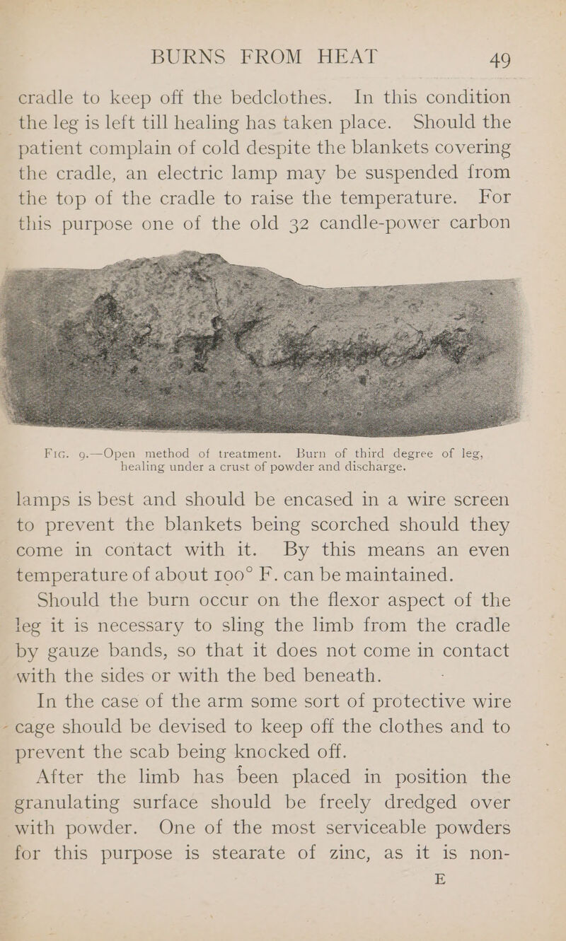 cradle to keep off the bedclothes. In this condition the leg is left till healing has taken place. Should the patient complain of cold despite the blankets covering the cradle, an electric lamp may be suspended from the top of the cradle to raise the temperature. For this purpose one of the old 32 candle-power carbon lamps is best and should be encased in a wire screen to prevent the blankets being scorched should they come in contact with it. By this means an even temperature of about 100° F. can be maintained. Should the burn occur on the flexor aspect of the leg it is necessary to sling the limb from the cradle by gauze bands, so that it does not come in contact with the sides or with the bed beneath. In the case of the arm some sort of protective wire cage should be devised to keep off the clothes and to prevent the scab being knocked off. After the limb has been placed in position the granulating surface should be freely dredged over with powder. One of the most serviceable powders for this purpose is stearate of zinc, as it is non- E \