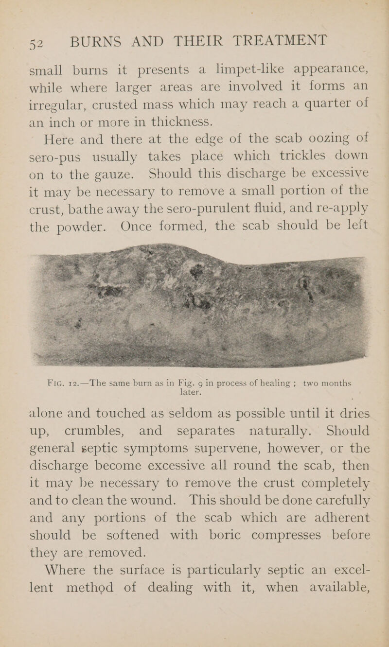 iki 52 BURNS AND THEIR TREATMENT a small burns it presents a limpet-lke appearance, while where larger areas are involved it forms an irregular, crusted mass which may reach a quarter of an inch or more in thickness. Here and there at the edge of the scab oozing of sero-pus usually takes place which trickles down on to the gauze. Should this discharge be excessive it may be necessary to remove a small portion of the crust, bathe away the sero-purulent fluid, and re-apply the powder. Once formed, the scab should be left alone and touched as seldom as possible until it dries up, crumbles, and separates naturally. Should general septic symptoms supervene, however, or the discharge become excessive all round the scab, then it may be necessary to remove the crust completely and to cleanthe wound. This should be done carefully and any portions of the scab which are adherent should be softened with boric compresses before they are removed. Where the surface is particularly septic an excel- lent method of dealing with it, when available,