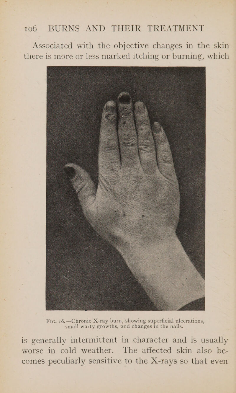 Associated with the objective changes in the skin there is more or less marked itching or burning, which is generally intermittent in character and is usually worse in cold weather. The affected skin also be- comes peculiarly sensitive to the X-rays so that even