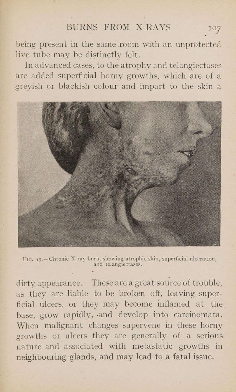 being present in the same room with an unprotected live tube may be distinctly felt. In advanced cases, to the atrophy and telangiectases are added superficial horny growths, which are of a greyish or blackish colour and impart to the skin a &gt; dirty appearance. These area great source of trouble, as they are liable to be broken off, leaving super- ficial ulcers, or they may become inflamed at the. base, grow rapidly, -and develop into carcinomata. When malignant changes supervene in these horny growths or ulcers they are generally of a serious nature and associated with metastatic growths in neighbouring glands, and may lead to a fatal issue.