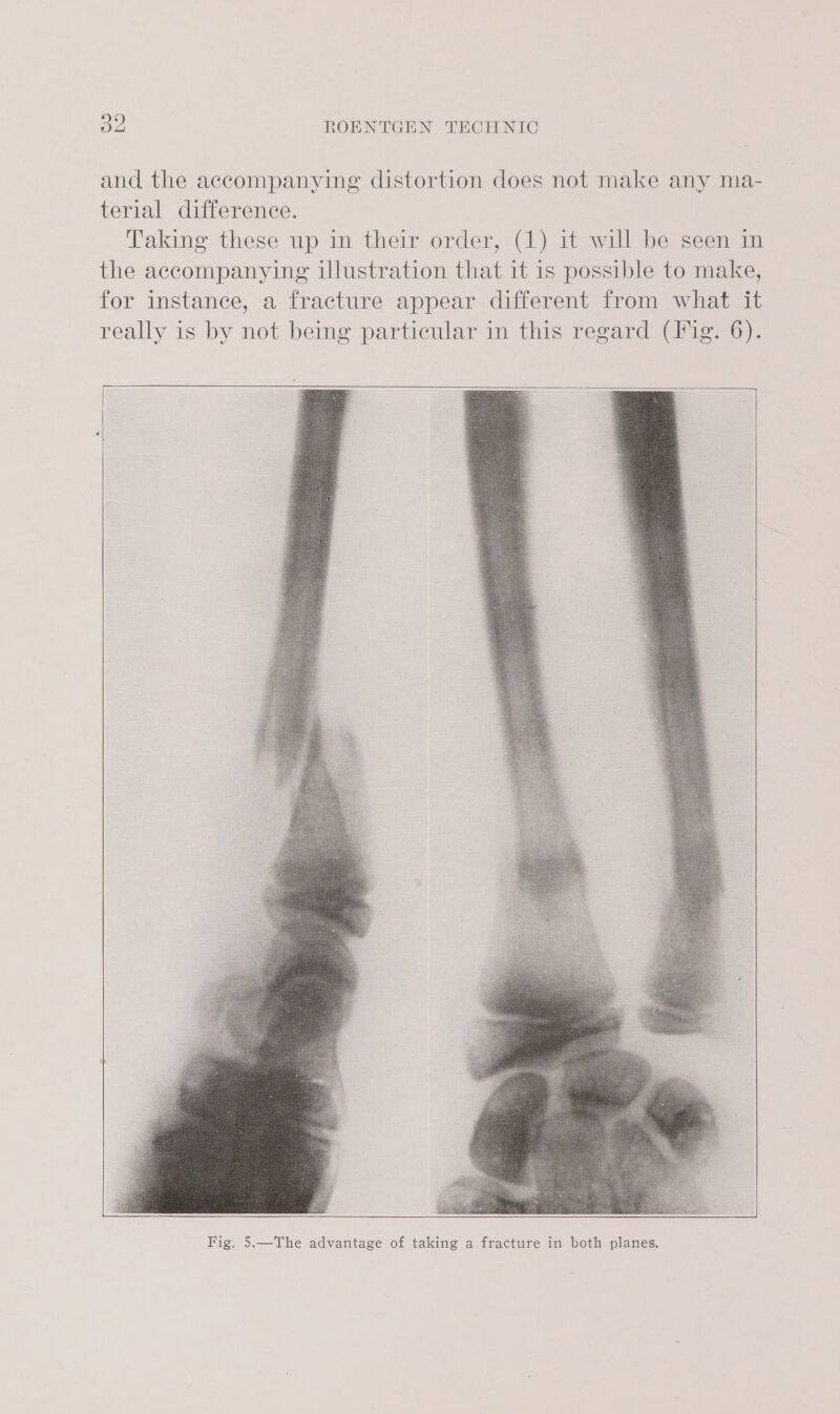 and the accompanying distortion does not make any ma- terial difference. Taking these up in their order, (1) it will be seen in the accompanying illustration that it is possible to make, for instance, a fracture appear different from what it really is by not being particular in this regard (Fig. 6).