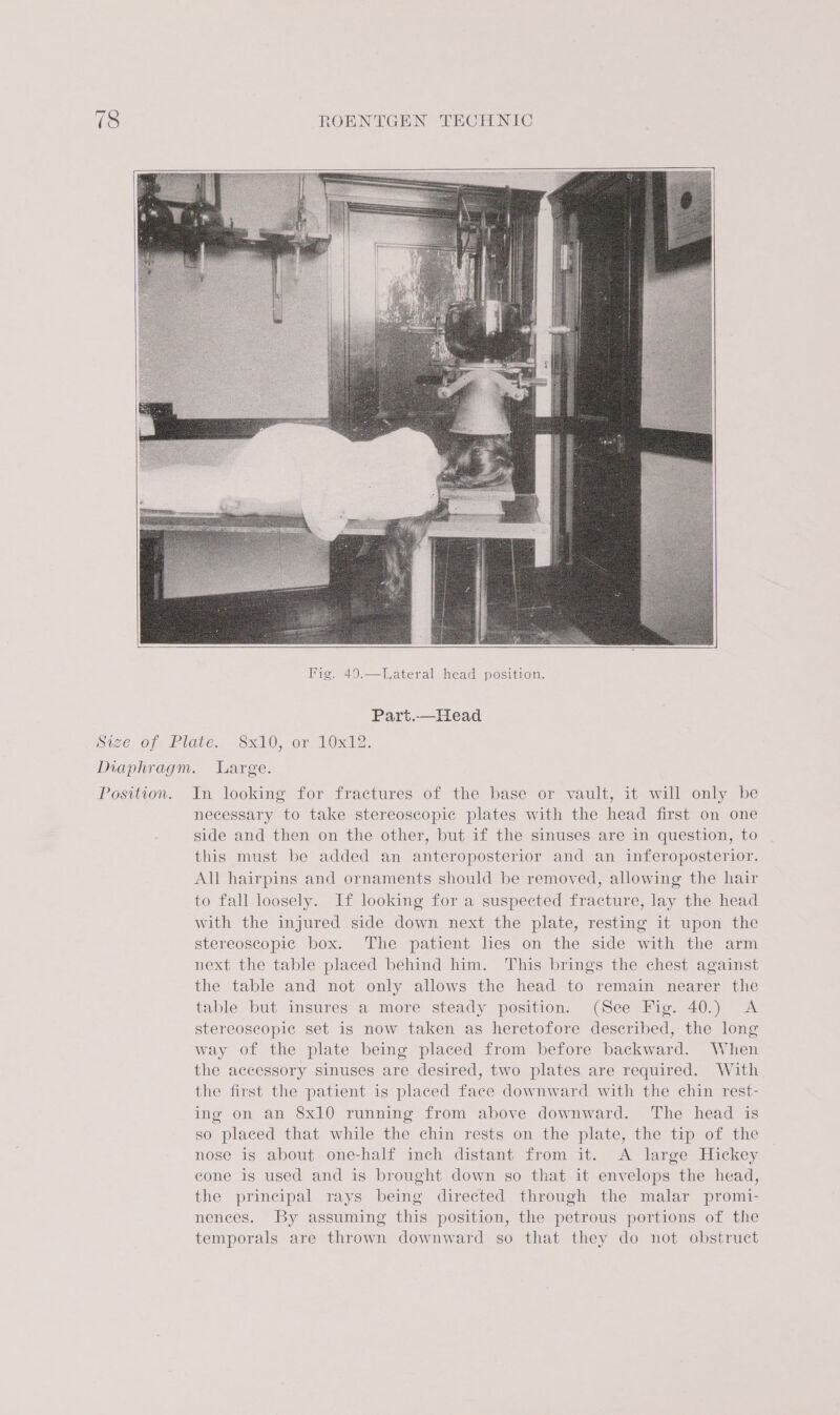 Fig. 40.—Lateral head position. Part.—Head Position. In looking for fractures of the base or vault, it will only be necessary to take stereoscopic plates with the head first on one side and then on the other, but if the sinuses are in question, to this must be added an anteroposterior and an inferoposterior. All hairpins and ornaments should be removed, allowing the hair to fall loosely. If looking for a suspected fracture, lay the head with the injured side down next the plate, resting it upon the stereoscopic box. The patient lies on the side with the arm next the table placed behind him. This brings the chest against the table and not only allows the head to remain nearer the table but insures a more steady position. (See Fig. 40.) A stereoscopic set is now taken as heretofore described, the long way of the plate being placed from before backward. When the accessory sinuses are desired, two plates are required. With the first the patient is placed face downward with the chin rest- ing on an 8x10 running from above downward. The head is so placed that while the chin rests on the plate, the tip of the nose is about one-half inch distant from it. A large Hickey cone is used and is brought down so that it envelops the head, the principal rays being directed through the malar promi- nences. By assuming this position, the petrous portions of the temporals are thrown downward so that they do not obstruct