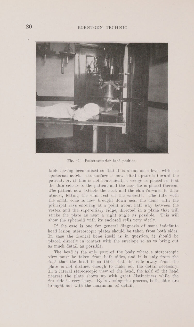 table having been raised so that it is about on a level with the episternal notch. Its surface is now tilted upwards toward the patient, or, if this is not convenient, a wedge is placed so that the thin side is to the patient and the cassette is placed thereon. The patient now extends the neck and the chin forward to their utmost, letting the chin rest on the cassette. The tube with the small cone is now brought down near the dome with the principal rays entering at a point about half way between the vertex and the superciliary ridge, directed in a plane that will strike the plate as near a right angle as possible. This will show the sphenoid with its enclosed cells very nicely. If the case is one for general diagnosis of some indefinite head lesion, stereoscopic plates should be taken from both sides. In case the frontal bone itself is in question, it should be placed directly in contact with the envelope so as to bring out as much detail as possible. The head is the only part of the body where a stereoscopic view must be taken from both sides, and it is only from the fact that the head is so thick that the side away from the plate is not distinct enough to make out the detail necessary. In a lateral stereoscopic view of the head, the half of the head nearest the plate shows up with great distinctness while the far side is very hazy. By reversing the process, both sides are brought out with the maximum of detail.