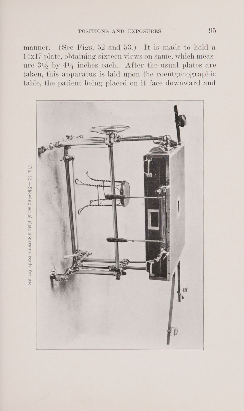 manner. (See Figs. 52 and 53.) It is made to hold a 14x17 plate, obtaining sixteen views on same, which meas- ure 314 by 414 inches each. After the usual plates are taken, this apparatus is laid upon the roentgenographie table, the patient being placed on it face downward and ‘TS “SIT ‘osn Ioy Apvor snyeiedde o}e[d [elias BuIMOoYS