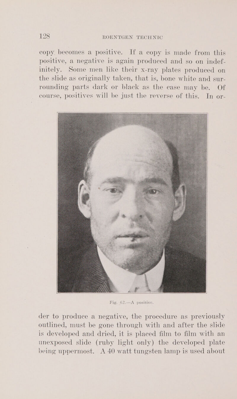 copy. becomes a positive. If a copy is made from this positive, a negative is again produced and so on indef- initely. Some men like their x-ray plates produced on the shde as originally taken, that is, bone white and sur- rounding parts dark or black as the case may be. Of course, positives will be just the reverse of this. In or- der to produce a negative, the procedure as previously outlined, must be gone through with and after the slide is developed and dried, it is placed film to film with an unexposed shde (ruby hght only) the developed plate being uppermost. A 40 watt tungsten lamp is used about