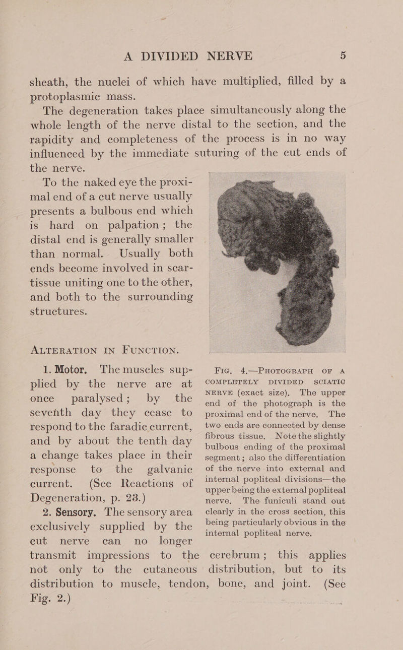 sheath, the nuclei of which have multiplied, filled by a protoplasmic mass. The degeneration takes place simultaneously along the whole length of the nerve distal to the section, and the rapidity and completeness of the process is In no way influenced by the immediate suturing of the cut ends of the-ner ve. To the naked eye the proxi- mal end of a cut nerve usually presents a bulbous end which is hard on palpation; the distal end is generally smaller than normal. Usually both ends become involved in scar- tissue uniting one to the other, and both to the surrounding structures. ALTERATION IN FUNCTION. 1. Motor. The muscles sup- Fie. 4.—PHOTOGRAPH OF A plied by the nerve are at COMPLETELY DIVIDED SCIATIC : NERVE (exact size). The upper he paralysed ; by the end of the photograph is the seventh day they cease to proximal endof the nerve. The respond to the faradic current, two ends are connected by dense fibrous tissue, Note the slightly and by about the tenth day bulbous ending of the proximal a change takes place in their segment; also the differentiation response to the galvanic of the nerve into external and pace ts (See Pescrions ot internal popliteal divisions—the upper being the external popliteal Degeneration, p: 23.) nerve. The funiculi stand out 2. Sensory. The sensory area clearly in the cross section, this exclusively supplied by the being particularly obvious in the internal popliteal nerve. cul, “herve: can no longer transmit impressions to the cerebrum; this applies not only to the cutaneous distribution, but to its distribution to muscle, tendon, bone, and joint. (See Fig; 2.)