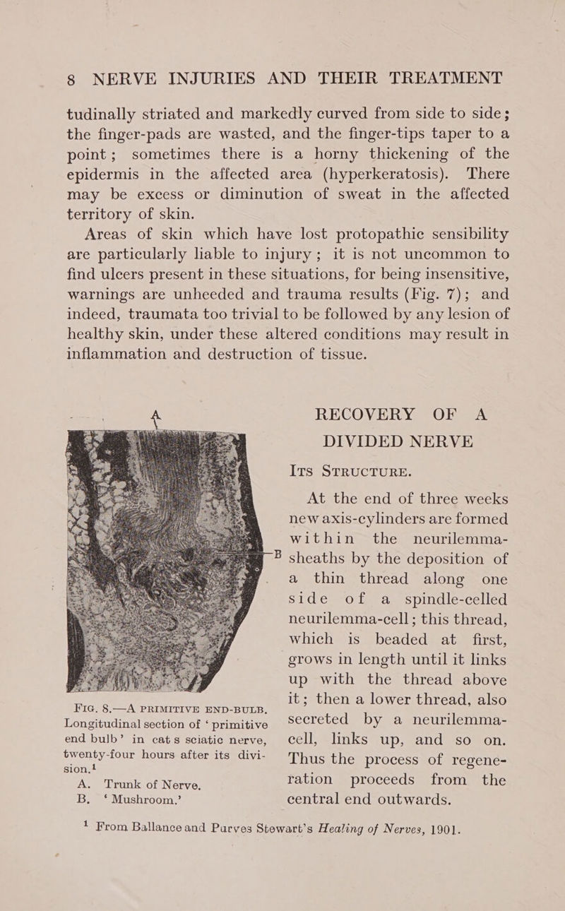 tudinally striated and markedly curved from side to side; the finger-pads are wasted, and the finger-tips taper to a point; sometimes there is a horny thickening of the epidermis in the affected area (hyperkeratosis). There may be excess or diminution of sweat in the affected territory of skin. Areas of skin which have lost protopathic sensibility are particularly liable to injury; it is not uncommon to find ulcers present in these situations, for being insensitive, warnings are unheeded and trauma results (Fig. 7); and indeed, traumata too trivial to be followed by any lesion of healthy skin, under these altered conditions may result in inflammation and destruction of tissue. RECOVERY OF A DIVIDED NERVE Irs STRUCTURE. At the end of three weeks new axis-cylinders are formed within the neurilemma- B sheaths by the deposition of a thin thread along one side of a spindle-celled neurilemma-cell ; this thread, which is beaded at first, grows in length until it links up with the thread above Fic. §8.—A PRIMITIVE END-BULB, nu Pa Len ileIeaAe, ae Longitudinal section of ‘ primitive secreted by a neurilemma- end bulb’ in cats sciatic nerve, cell, links up, and so on. eee hours after its divi- Thus the process of regene- eee eerneron ration proceeds from the B. ‘ Mushroom,’ central end outwards. 1 From Ballance and Purves Stewart’s Healing of Nerves, 1901.