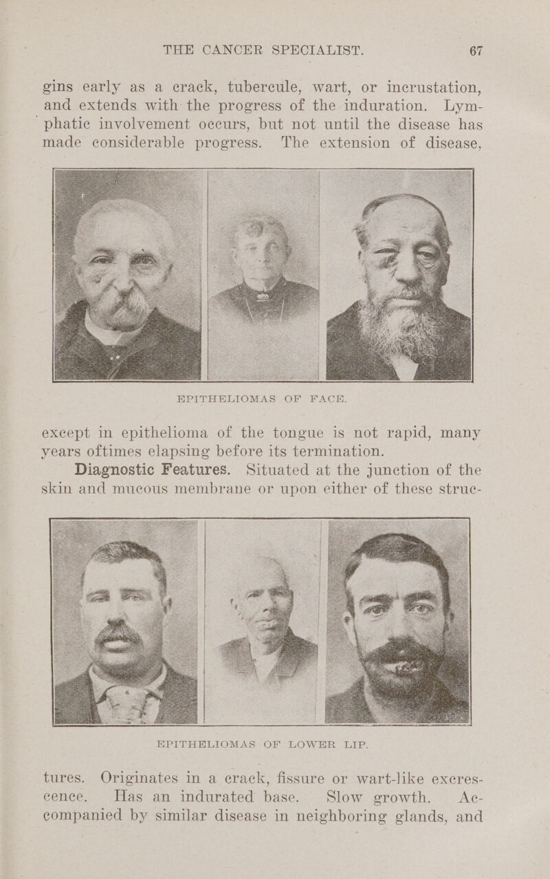 gins early as a crack, tubercule, wart, or incrustation, and extends with the progress of the induration. Lym- ‘phatic involvement occurs, but not until the disease has made considerable progress. The extension of disease, EPITHELIOMAS -OF BACH. except in epithelioma of the tongue is not rapid, many years oftimes elapsing before its termination. Diagnostic Features. Situated at the junction of the skin and mucous membrane or upon either of these struc- tures. Originates in a crack, fissure or wart-like excres- eence. Has an indurated base. Slow growth. Ac- companied by similar disease in neighboring glands, and