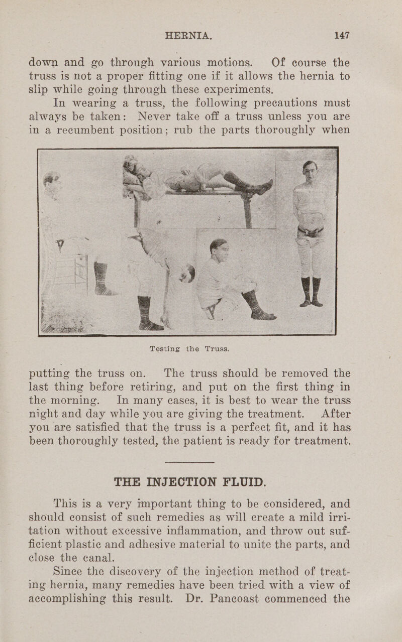 down and go through various motions. Of course the truss is not a proper fitting one if it allows the hernia to slip while going through these experiments. In wearing a truss, the following precautions must always be taken: Never take off a truss unless you are in a recumbent position; rub the parts thoroughly when putting the truss on. The truss should be removed the last thing before retiring, and put on the first thing in the morning. In many cases, it is best to wear the truss night and day while you are giving the treatment. After you are satisfied that the truss is a perfect fit, and it has been thoroughly tested, the patient is ready for treatment. THE INJECTION FLUID. This is a very tmportant thing to be considered, and should consist of such remedies as will create a mild irri- tation without excessive inflammation, and throw out suf- ficient plastic and adhesive material to unite the parts, and close the canal. Since the discovery of the injection method of treat- ing hernia, many remedies have been tried with a view of accomplishing this result. Dr. Pancoast commenced the