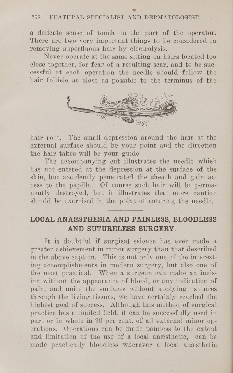 a delicate sense of touch on the part of the operator. There are two very important things to be considered in removing superfluous hair by electrolysis. Never operate at the same sitting on hairs located too close together, for fear of a resulting sear, and to be suc- cessful at each operation the needle should follow the hair follicle as close as possible to the terminus of the hair root. The small depression around the hair at the external surface should be your point and the direction the hair takes will be your guide, The accompanying cut illustrates the needle which has not entered at the depression at the surface of the skin, but accidently penetrated the sheath and gain ac- cess to the papilla. Of course such hair will be perma- nently destroyed, but it illustrates that more caution should be exercised in the point of entering the needle. LOCAL ANAESTHESIA AND PAINLESS, BLOODLESS AND SUTURELESS SURGERY. It is doubtful if surgical science has ever made a oreater achievement in minor surgery than that described in the above caption. This is not only one of the interest- ing accomplishments in modern surgery, but also one of the most practical. When a surgeon can make an incis- ion without the appearance of blood, or any indication of pain, and unite the surfaces without applying sutures through the living tissues, we have certainly reached the highest goal of success. Although this method of surgical practice has a limited field, it can be successfully used in part or in whole in 90 per cent. of all external minor op- erations. Operations can be made. painless to the extent and limitation of the use of a local anesthetic, can be made practically bloodless wherever a local anesthetic —=_ ee ee ee a