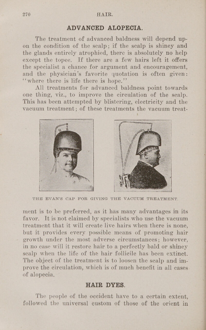 ADVANCED ALOPECIA. The treatment of advanced baldness will depend up- on the condition of the scalp; if the scalp is shiney and the glands entirely atrophied, there is absolutely no help except the topee. If there are a few hairs left it offers the specialist a chance for argument and encouragement, and the physician’s favorite quotation is often given: ‘‘where there is life there is hope.”’ All treatments for advanced baldness point towards one thing, viz., to improve the circulation of the scalp. This has been attempted by blistering, electricity and the vacuum treatment; of these treatments the vacuum treat- THE EVAN’S CAP FOR GIVING THE VACUUM TREATMENT. ment is to be preferred, as it has many advantages in its favor. It is not claimed by specialists who use the vacuum treatment that it will create live hairs when there is none, but it provides every possible means of promoting hair gerowth under the most adverse circumstances; however, in no case will it restore hair to a perfectly bald or shiney scalp when the life of the hair follicile has been extinct. The object of the treatment is to loosen the sealp and im- prove the circulation, which is of much benefit in all cases of alopecia. HAIR DYES. The people of the occident have to a certain extent, followed the universal custom of those of the orient in