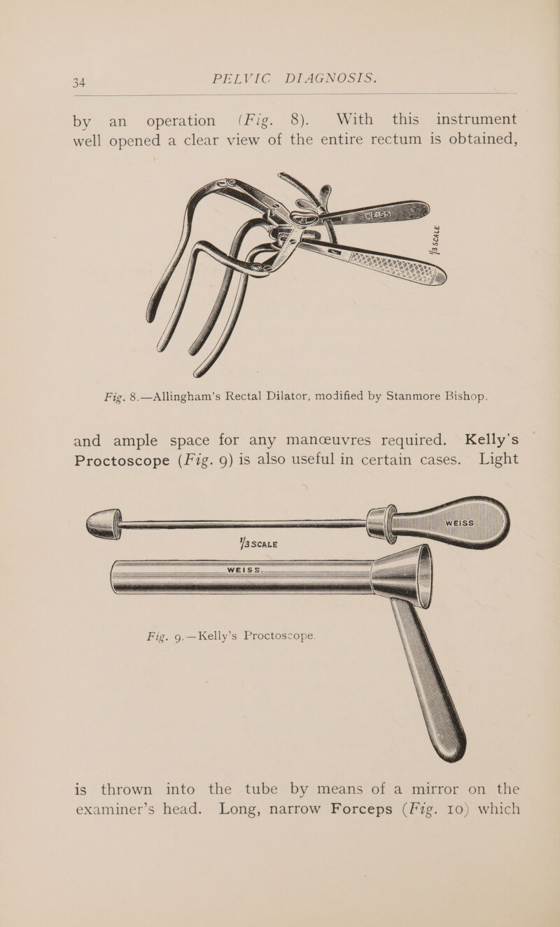 by an operation (Fig. 8). With this instrument well opened a clear view of the entire rectum 1s obtained, Fig. 8.—Allingham’s Rectal Dilator, modified by Stanmore Bishop. and ample space for any manceuvres required. Kelly’s Proctoscope (fig. 9) is also useful in certain cases. Light Fig. 9.—Kelly’s Proctoscope. is thrown into the tube by means of a mirror on the examiner’s head. Long, narrow Forceps (f7g. 10) which