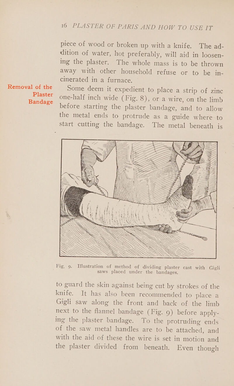 Removal of the Plaster Bandage 16 PLASTER OF PARIS AND HOW TO USE IT piece of wood or broken up with a knife. The ad- dition of water, hot preferably, will aid in loosen- ing the plaster. The whole mass is to be thrown away with other household refuse or to be in- cinerated in a furnace. Some deem it expedient to place a strip of zinc one-half inch wide (Fig. 8), or a wire, on the limb before starting the plaster bandage, and to allow the metal ends to protrude as a guide where to start cutting the bandage. The metal beneath is IS SN \ \\)\ ’ AN SSN \ \ eS fess) saws placed under the bandages. to guard the skin against being cut by strokes of the knife. It has also been recommended to place a Gigli saw along the front and back of the limb next to the flannel bandage (Fig. 9) before apply- ing the plaster bandage. To the protruding ends of the saw metal handles are to be attached, and with the aid of these the wire is set in motion and the plaster divided from beneath. Even though