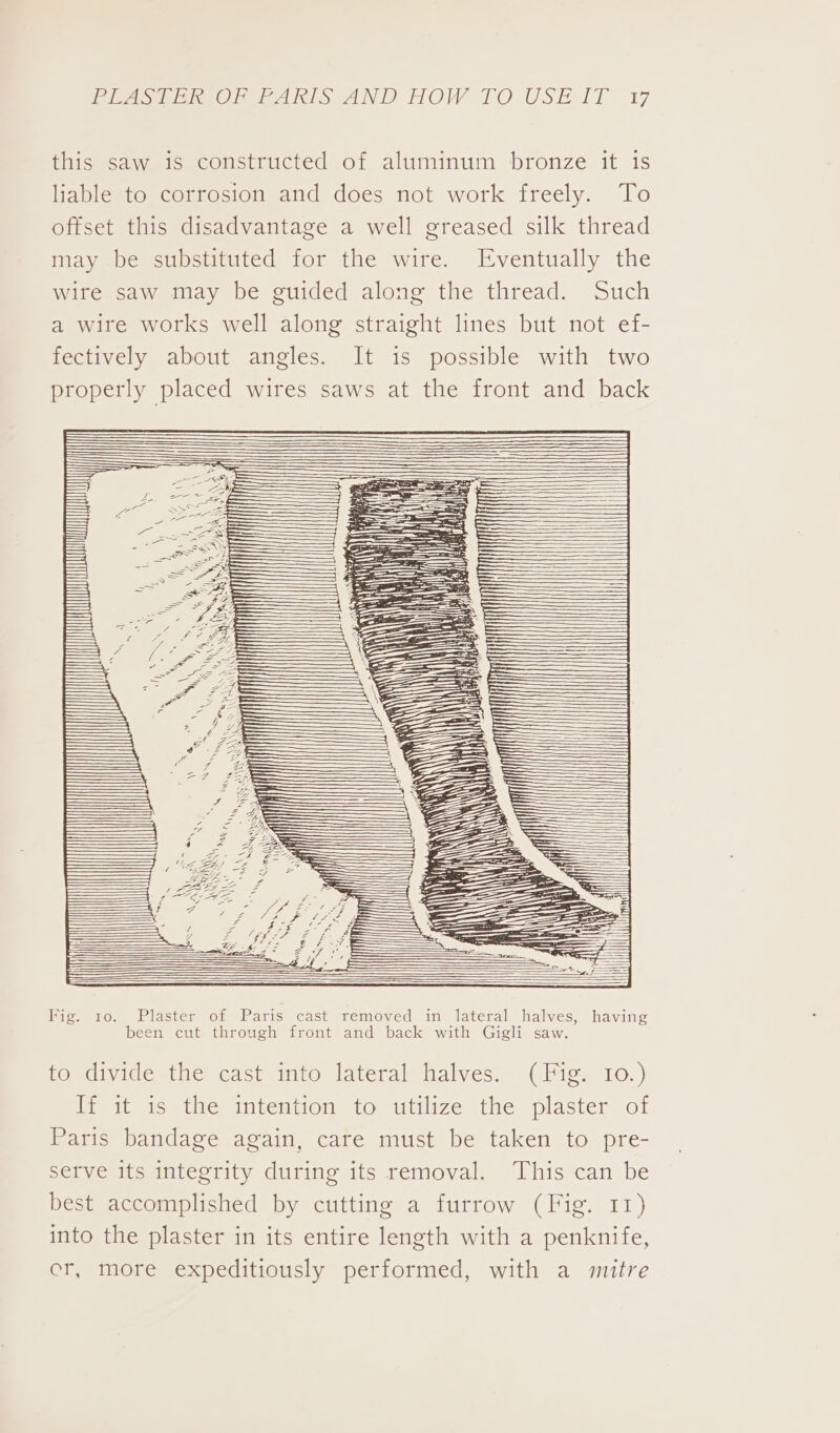 this saw is constructed of aluminum bronze it is liable to corrosion and does not work freely. To offset this disadvantage a well greased silk thread may be substituted for the wire. Eventually the wire saw may be guided along the thread. Such a wire works well along straight lines but not ef- fectively about angles. It is possible with two properly placed wires saws at the front and back : cry \\ ih Plaster of Paris cast removed in lateral halves, having been cut through front and back with Gigli saw. to divide the cast into lateral halves. (Fig. 10.) Dieta ioatlee iitenion toruuilize: themplaster of Paris bandage again, care must be taken to pre- serve its integrity during its removal. This can be best accomplished by cutting a furrow (Fig. 11) into the plaster in its entire length with a penknife, er, more expeditiously performed, with a mitre
