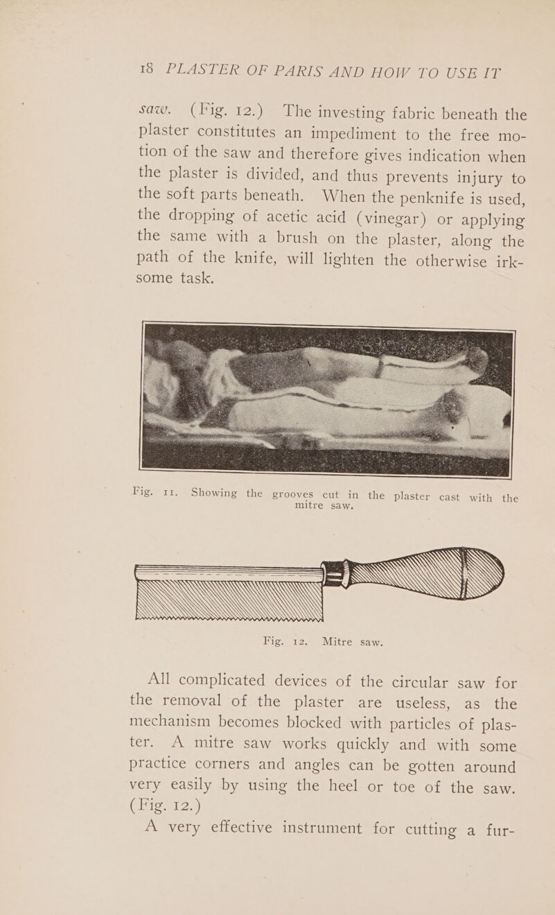 sav: ~ -( Hig, ohn life investing fabric beneath the plaster constitutes an impediment to the free mo- tion of the saw and therefore gives indication when the plaster is divided, and thus prevents injury to the soft parts beneath. When the penknife is used, the dropping of acetic acid (vinegar) or applying the same with a brush on the plaster, along the path of the knife, will lighten the otherwise irk- some task, Fig. 11. Showing the grooves cut in the plaster cast with the mitre saw. All complicated devices of the circular saw for the removal of the plaster are useless, as the mechanism becomes blocked with particles of plas- ter. A mitre saw works quickly and with some practice corners and angles can be gotten around very easily by using the heel or toe of the saw. (Fig. 12.) | A very effective instrument for cutting a fur-