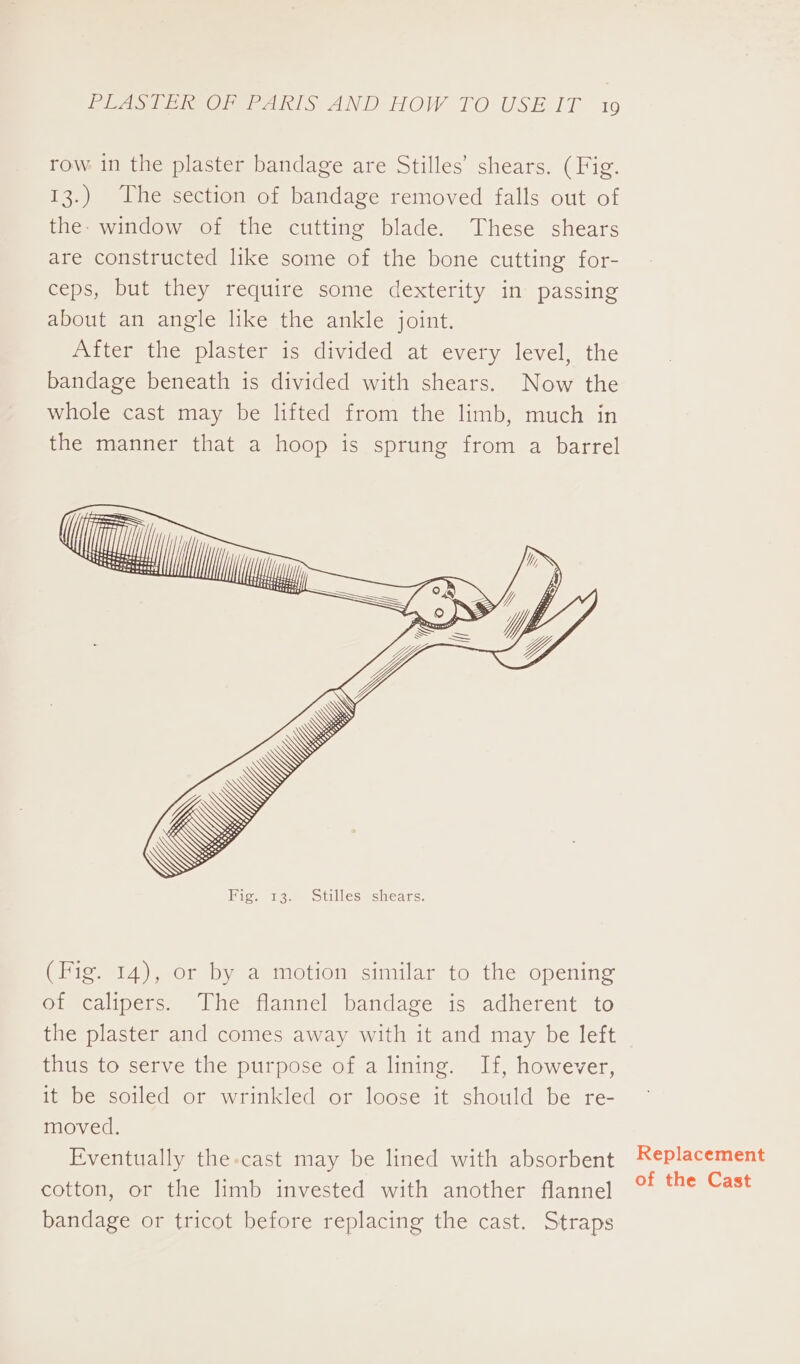 PAS ie OnE aks AND HOW £O USE IT 10 row in the plaster bandage are Stilles’ shears. (Fig. 13.) The section of bandage removed falls out of the- window of the cutting blade. These shears are constructed like some of the bone cutting for- ceps, but they require some dexterity in passing about an angle like the ankle joint. After the plaster is divided at every level, the bandage beneath is divided with shears. Now the whole cast may be lifted from the limb, much in the manner that a hoop is sprung from a barrel (Fig. 14), or by a motion similar to the opening of calipers. The flannel bandage is adherent to the plaster and comes away with it and may be left thus to serve the purpose of a lining. If, however, it be soiled or wrinkled or loose it should be re- moved. Eventually the-cast may be lined with absorbent cotton, or the limb invested with another flannel bandage or tricot before replacing the cast. Straps Replacement of the Cast