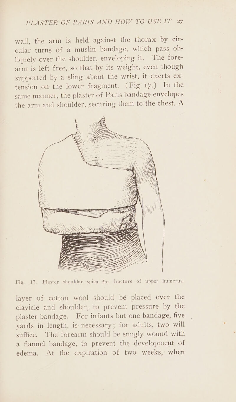 wall, the arm is held against the thorax by cir- cular turns of a muslin bandage, which pass ob- liquely over the shoulder, enveloping it. hertore arm is left free, so that by its weight, even though supported by a sling about the wrist, it exerts ex- tension on the lower fragment. (Fig 17.) In the saine manner, the plaster of Paris bandage envelopes the arm and shoulder, securing them to the chest. A Gr Se \ SS Te e ' . SEEN NAN ~ SSS We SS Tig. 17. Plaster shoulder spica for fracture of upper humerus. layer of cotton wool should be placed over the clavicle and shoulder, to prevent pressure by the plaster bandage. For infants but one bandage, five yards in length, is necessary; for adults, two will suffice. The forearm should be snugly wound with a flannel bandage, to prevent the development of edema. At the expiration of two weeks, when