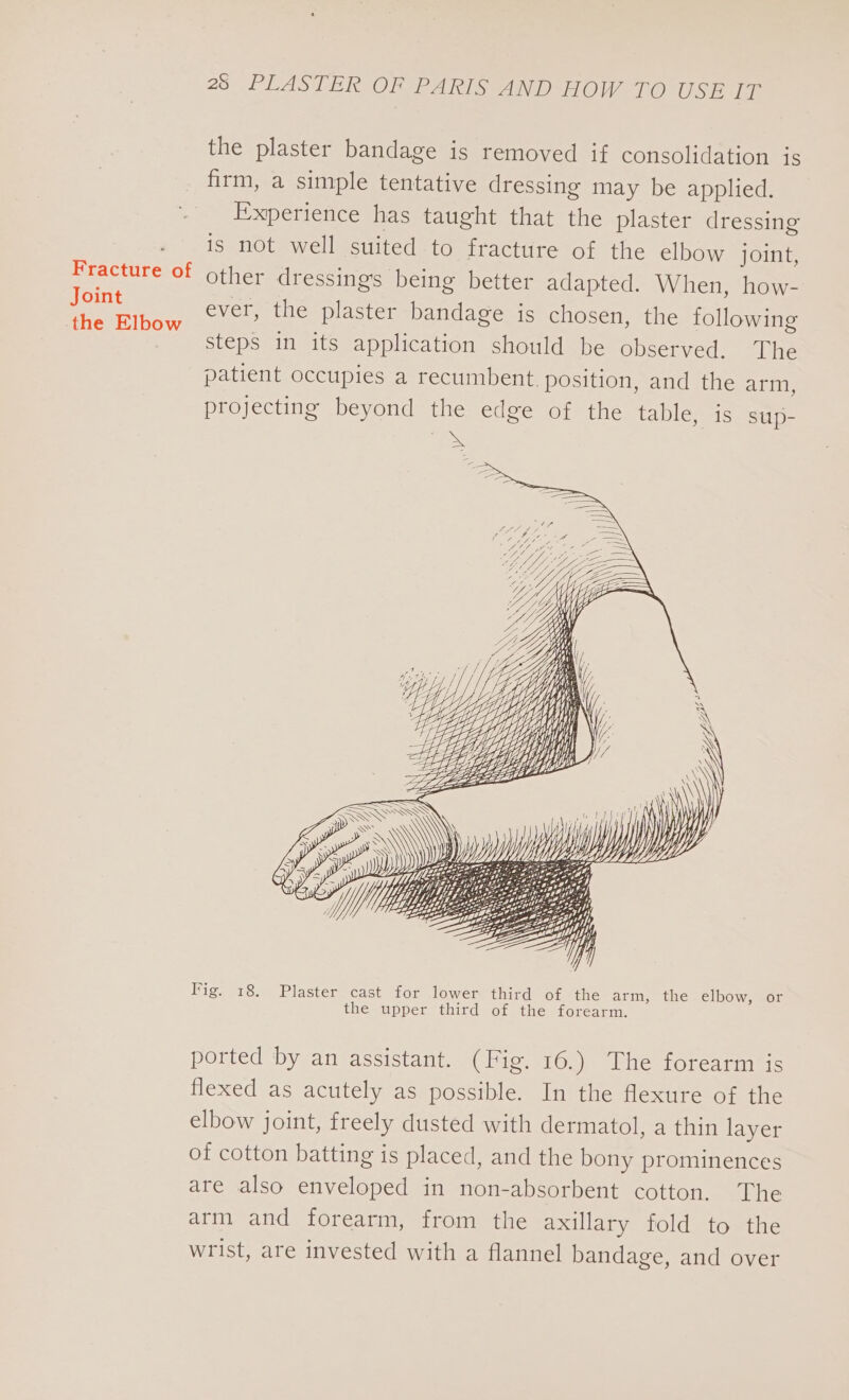 Joint the Elbow 28 PLASTER OF PARIS ANDsHOW TO USE it the plaster bandage is removed if consolidation is firm, a simple tentative dressing may be applied. Experience has taught that the plaster dressing is not well suited to fracture of the elbow joint, other dressings being better adapted. When, how- ever, the plaster bandage is chosen, the following steps in its application should be observed. The patient occupies a recumbent. position, and the arm, projecting beyond the edge of the table, is sup- WO Se AS ss Ss SBS: . SS \ \ SSO “SS = Se \N SSS Se == = ~wNSS SSS Sos =&gt;, + Ss a —= SS ~ tiza &lt;s AS if tii hiy SPLIT hy Lie | S LI, epi) Y// SA IF ZEBRA \ a ZZ _a A \\\ 5 ST \ Wilt ili \ Wy PE A\\\ yA WWW yy A) LILA Ait od LG? the upper third of the forearm.