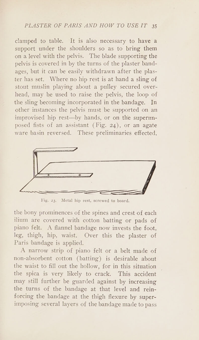 clamped to table. It is also necessary to have a support under the shoulders so as to bring them on a level with the pelvis. The blade supporting the pelvis is covered in by the turns of the plaster band- ages, but it can be easily withdrawn after the plas- ter has set. Where no hip rest is at hand a sling of stout muslin playing about a pulley secured over- head, may be used to raise the pelvis, the loop of the sling becoming incorporated in the bandage. In other instances the pelvis must be supported on an improvised hip rest—by hands, or on the superim- posed fists Of an assistant (Pig) 24), or an-agate ware basin reversed. These preliminaries effected, the bony prominences of the spines and crest of each ilitum are covered with cotton batting or pads of piano felt. A flannel bandage now invests the foot, leg, thigh, hip, waist. Over this the plaster of Paris bandage is applied. A narrow strip of piano felt or a belt made of non-absorbent cotton (batting) is desirable about the waist to fill out the hollow, for in this situation the spica is very likely to crack. This accident may still further be guarded against by increasing the turns of the bandage at that level and rein- forcing the bandage at the thigh flexure by super- imposing several layers of the bandage made to pass