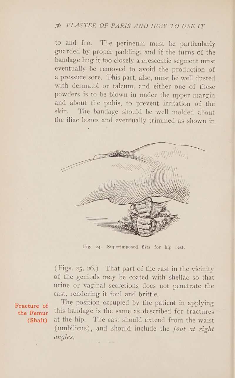 the Femur (Shaft) 36 PLASTER OP PARIS AND HOW TO USE 12 to and fro. The perineum must be particularly guarded by proper padding, and if the turns of the bandage hug it too closely a crescentic segment must eventually be removed to avoid the production of a pressure sore. This part, also, must be well dusted with dermatol or talcum, and either one of these powders is to be blown in under the upper margin and about the pubis, to prevent irritation of the skin. The bandage should be well molded about the iliac bones and eventually trimmed as shown in a ELE A, ors \\ \ : Se ee SQ Se ‘i | ie 1 i} 1| ha “iN // Why, Vy Yyy WY ay / Mp fist H ~&lt;a i lif = &lt;&lt; Zz UY We” = = SSS SS SS ——— —_ Fig. 24. Superimposed fists for hip rest. (Figs. 25, 26.) That part of the cast in the vicinity of the genitals may be coated with shellac so that urine or vaginal secretions does not penetrate the cast, rendering it foul and brittle. The position occupied by the patient in applying this bandage is the same as described for fractures at the hip. The cast should extend from the waist (umbilicus), and should include the foot at right angles,