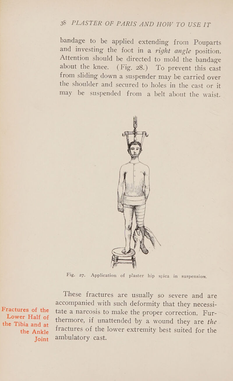 Fractures of the Lower Half of the Tibia and at the Ankle Joint ae PLAS TEROOM ARIS AND HOW TO USE aE bandage to be applied extending from Pouparts and investing the foot in a right angle position. Attention should be directed to mold the bandage about the knee. (Fig. 28.) To prevent this cast from sliding down a suspender may be carried over the shoulder and secured to holes in the cast or it may be suspended from a belt about the waist. Fig. 27. Application of plaster hip spica in suspension. These fractures are usually so severe and are accompanied with such deformity that they necessi- tate a narcosis to make the proper correction. Fur- thermore, if unattended by a wound they are the fractures of the lower extremity best suited for the ambulatory cast.