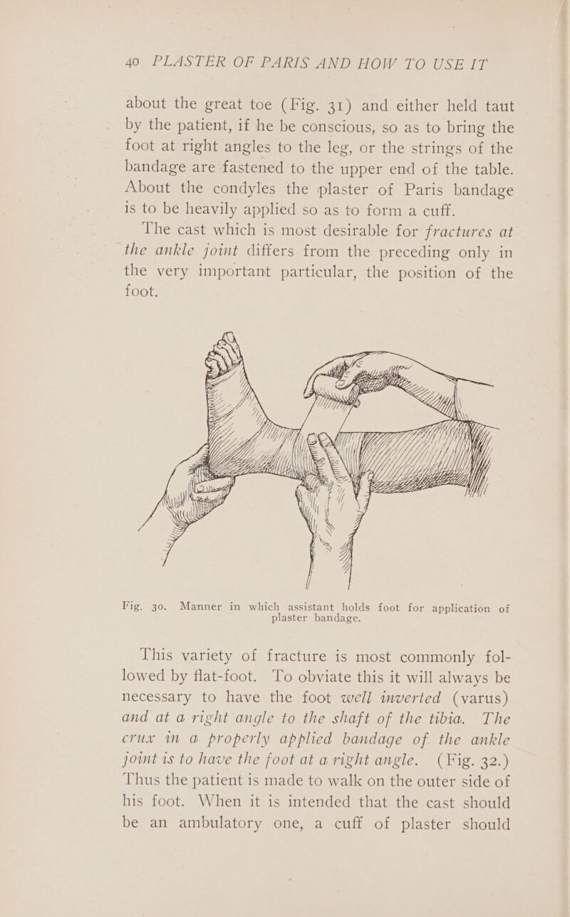 about the great toe (Fig. 31) and either held taut by the patient, if he be conscious, so as to bring the foot at right angles to the leg, or the strings of the bandage are fastened to the upper end of the table. About the condyles the plaster of Paris bandage is to be heavily applied so as to form a cuff. The cast which is most desirable for fractures at the ankle joint differs from the preceding only in the very important particular, the position of the toot. Yi i; WH Wy WY, iy YY Lp Yh) | LLLP Fig. 30. Manner in which assistant holds foot for application of plaster bandage. This variety of fracture is most commonly fol- lowed by flat-foot. To obviate this it will always be necessary to have the foot well imverted (varus) and at a right angle to the shaft of the tibia. The crux in a&amp; properly applied bandage of the ankle joint 1s to have the foot at aright angle. (Fig. 32.) Thus the patient is made to walk on the outer side of his foot. When it is intended that the cast should be an ambulatory one, a cuff of plaster should