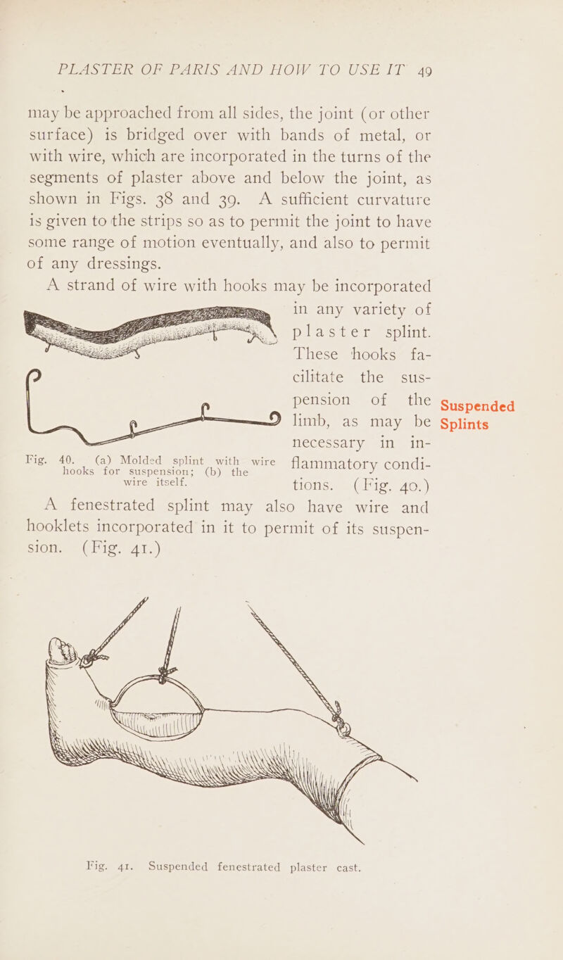 may be approached from all sides, the joint (or other surface) is bridged over with bands of metal, or with wire, which are incorporated in the turns of the segments of plaster above and below the joint, as shown in Figs. 38 and 39. A sufficient curvature is given to the strips so as to permit the joint to have some range of motion eventually, and also to permit of any dressings. A strand of wire with hooks may be incorporated in any variety of plaster splint. These hooks fa- cilitate the sus- pension of the limb, as may be necessary in in- oe ee ane flammatory condi- wire itself. tions. (Fig. 40.) A fenestrated splint may also have wire and hooklets incorporated in it to permit of its suspen- si0tm, = (Fig. 41.) SS ty A &gt;. SSS Suspended Splints