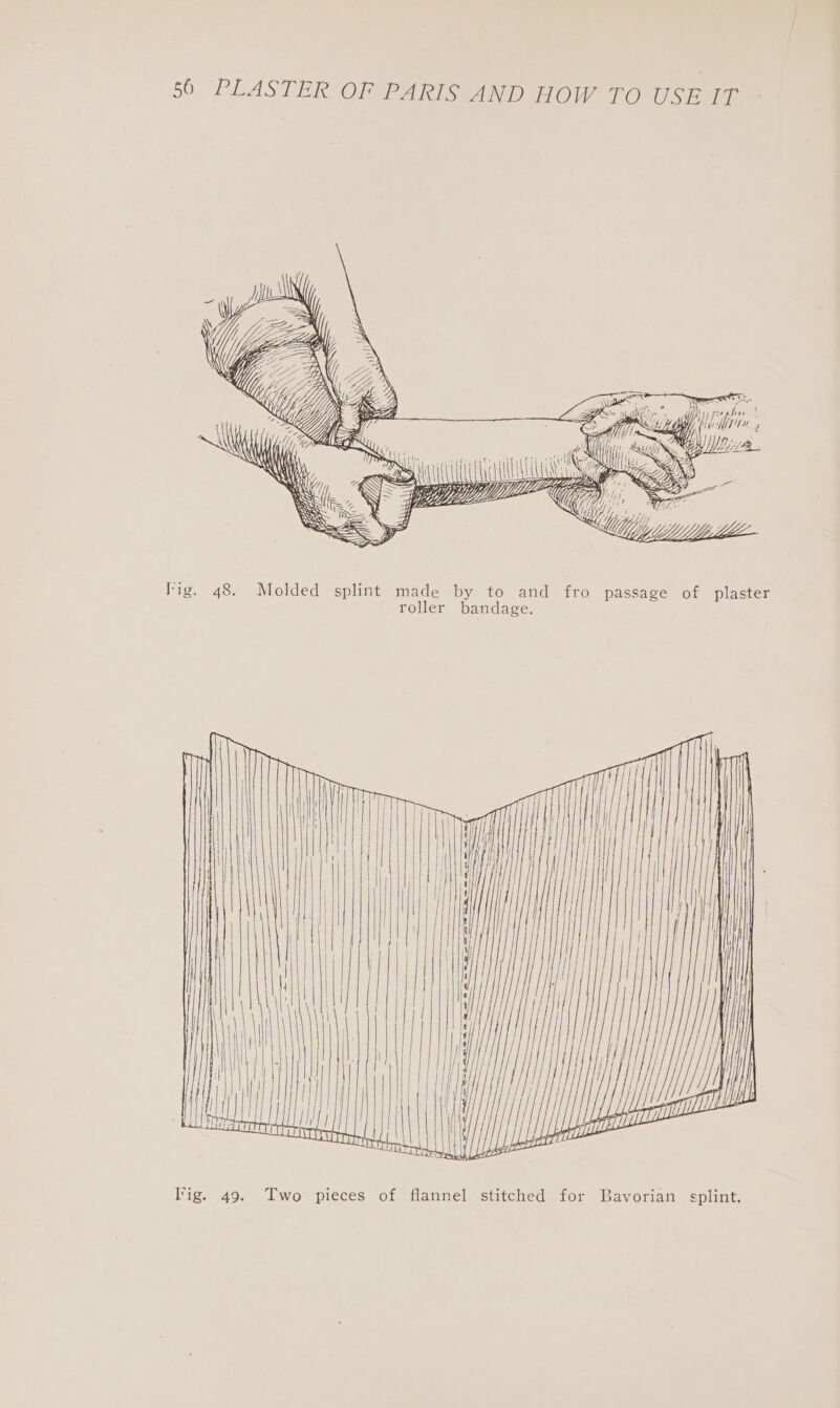 Ss. &gt; by ee ; y iy err, 7 7, SW Li) Weininw 2 7 Ady \ \ ae es ee OS = a ements — a -—o a ee a SS m —— l'ig. 49. Two pieces of flannel stitched for Bavorian splint.