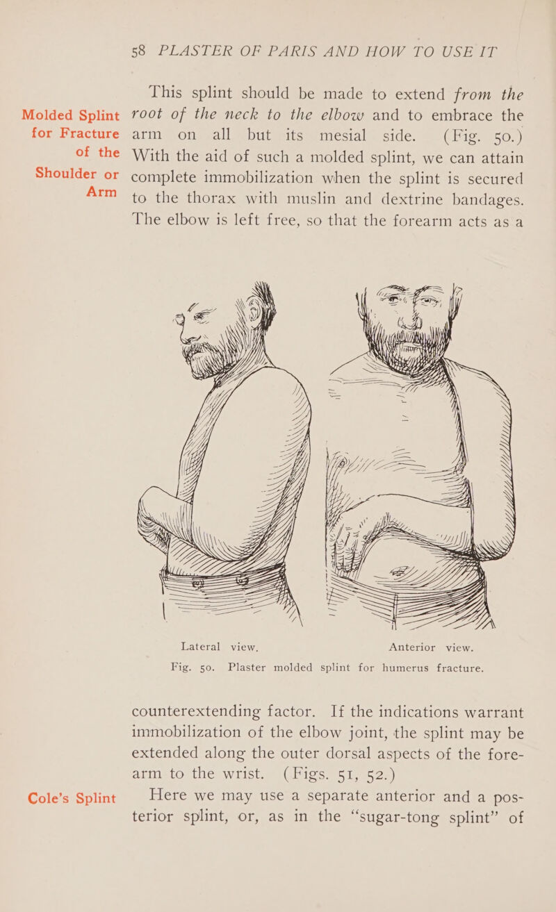 for Fracture of the Shoulder or Arm Cole’s Splint $8 PLASTERSOR PARIS AOR ON- TO Sea This splint should be made to extend from the arm on all but its mesial side. (Fig. 50.) With the aid of such a molded splint, we can attain complete immobilization when the splint is secured to the thorax with muslin and dextrine bandages. The elbow is left free, so that the forearm acts as a Fig. 50. Plaster molded splint for humerus fracture. counterextending factor. If the indications warrant immobilization of the elbow joint, the splint may be extended along the outer dorsal aspects of the fore- atmisto the wrist. iGbigs 51, 525) Here we may use a separate anterior and a pos- terior splint, or, as in the “sugar-tong splint” of