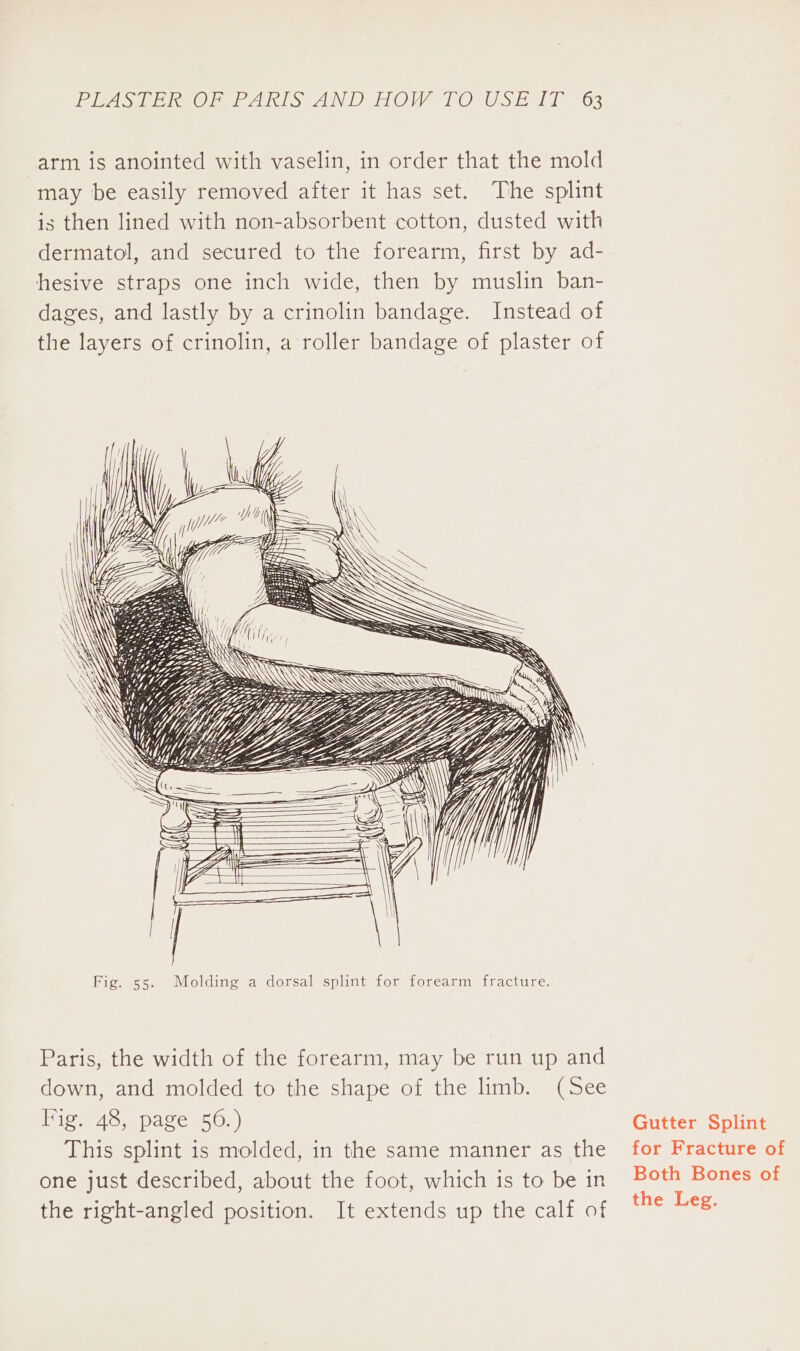 arm is anointed with vaselin, in order that the mold may be easily removed after it has set. The splint is then lined with non-absorbent cotton, dusted with dermatol, and secured to the forearm, first by ad- hesive straps one inch wide, then by muslin ban- dages, and lastly by a crinolin bandage. Instead of the layers of crinolin, a roller bandage of plaster of Paris, the width of the forearm, may be run up and down, and molded to the shape of the limb. (See Fig, 48, page 56.) This splint is molded, in the same manner as the one just described, about the foot, which is to be in the right-angled position. It extends up the calf of Gutter Splint for Fracture of Both Bones of the Leg.