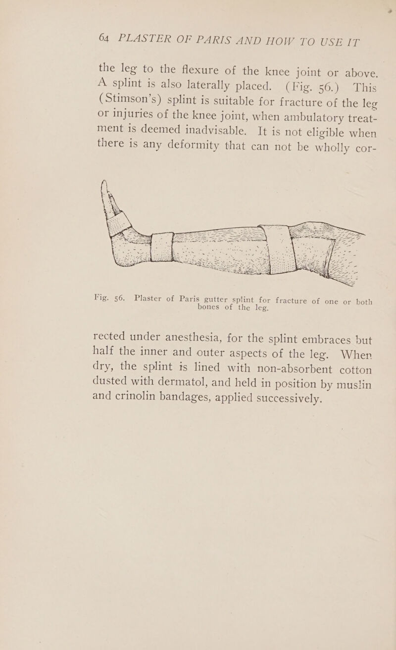 the leg to the flexure of the knee joint or above. A splint is also laterally placed. (Fig. 56.) This (Stimson’s) splint is suitable for fracture of the leg or injuries of the knee joint, when ambulatory treat- ment is deemed inadvisable. It is not eligible when there is any deformity that can not be wholly cor- Vig. 56. Plaster of Paris gutter splint for fracture of one or both bones of the leg. rected under anesthesia, for the splint embraces but half the inner and outer aspects of the leg. When dry, the splint is lined with non-absorbent cotton dusted with dermatol, and held in position by mustin and crinolin bandages, applied successively.