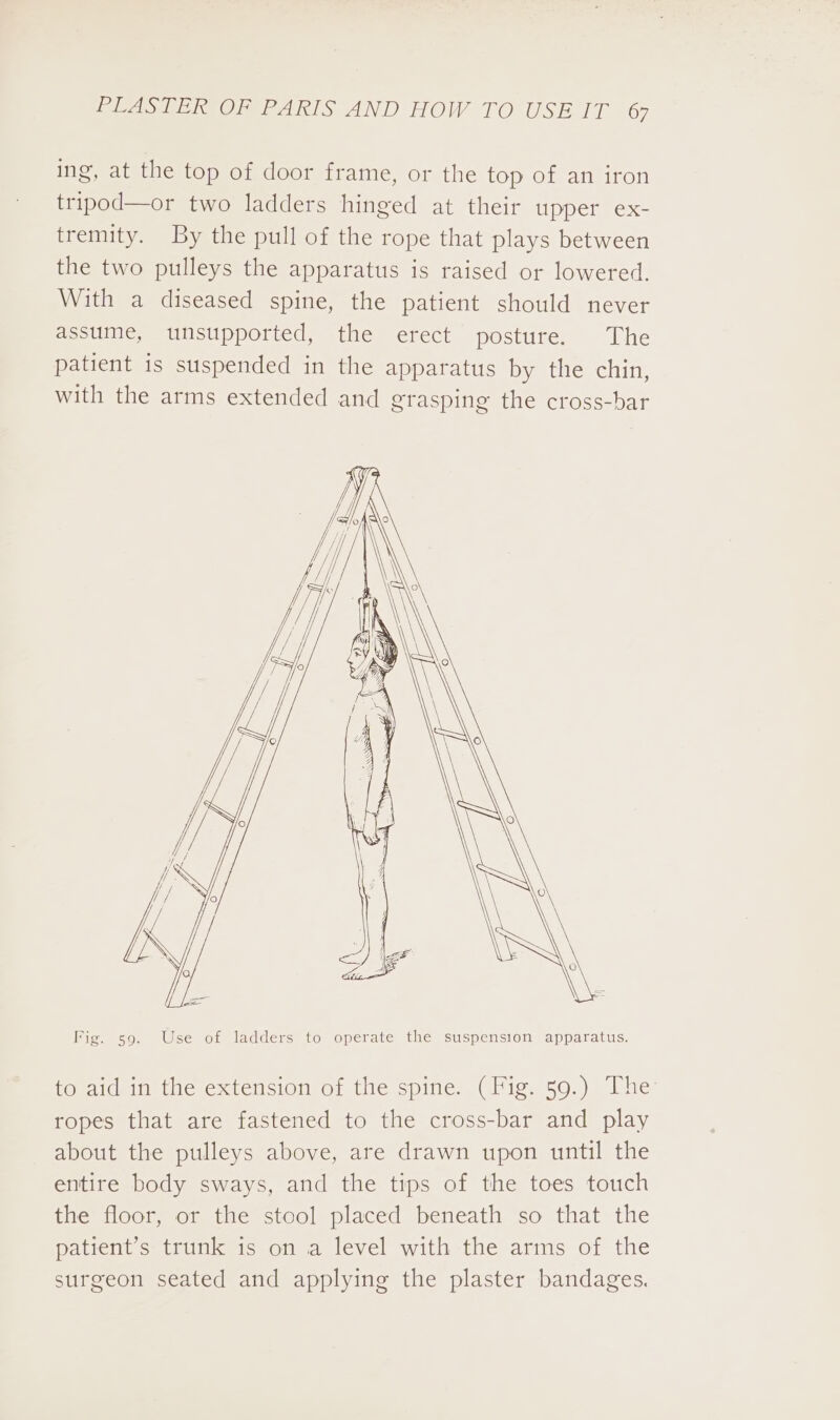 ing, at the top of door frame, or the top of an iron tripod—or two ladders hinged at their upper ex- tremity. By the pull of the rope that plays between the two pulleys the apparatus is raised or lowered. With a diseased spine, the patient should never assume, unsupported, the erect posture. The patient is suspended in the apparatus by the chin, with the arms extended and grasping the cross-bar Fig. s9. Use of ladders to operate the suspension apparatus. to aid in the extension of the spine. (Fig. 59.) The ropes that are fastened to the cross-bar and play about the pulleys above, are drawn upon until the entire body sways, and the tips of the toes touch the floor, or the stool placed beneath so that the patient’s trunk is on a level with the arms of the surgeon seated and applying the plaster bandages.