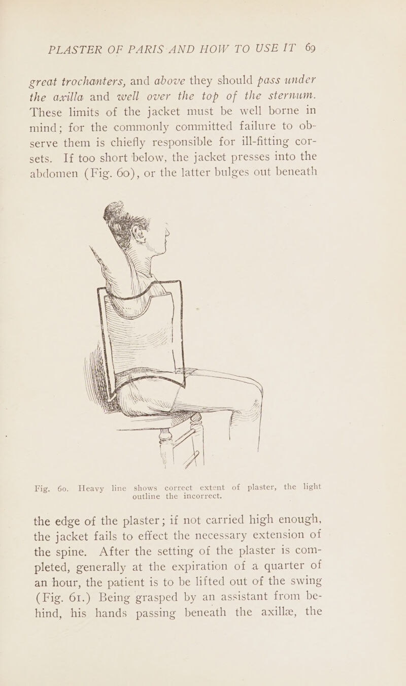 great trochanters, and above they should pass under the axilla and well over the top of the sternum. These limits of the jacket must be well borne in mind; for the commonly committed failure to ob- serve them is chiefly responsible for ill-fitting cor- sets. If too short below, the jacket presses into the abdomen (Fig. 60), or the latter bulges out beneath | | BBB ——— : Se a St Peas = Sa LF 2 —— x Fig. 60. Heavy line shows correct extent of plaster, the light outline the incorrect. the edge of the plaster; if not carried high enough, the jacket fails to effect the necessary extension of the spine. After the setting of the plaster is com- pleted, generally at the expiration of a quarter of an hour, the patient is to be lifted out of the swing (Fig. 61.) Being grasped by an assistant from be- hind, his hands passing beneath the axille, the