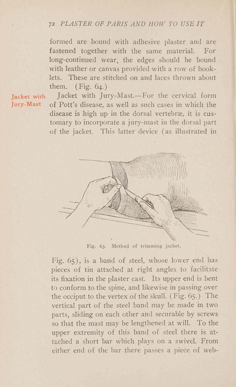 Jacket with Jury-Mast 72: PLASTER (OF FAR orAND HOW .1O Usiag formed are bound with adhesive plaster and are fastened together with the same material. For long-continued wear, the edges should be bound with leather or canvas provided with a row of hook- lets. These are stitched on and laces thrown about them. (Fig. 64.) Jacket with Jury-Mast—For the cervical form of Pott’s disease, as well as such cases in which the disease is high up in the dorsal vertebre, it is cus- tomary to incorporate a jury-mast in the dorsal part of the jacket. This latter device (as illustrated in AY WS xD ‘ AY \ \ \\\ 4 \ \\\\\} \ \\ \ \ ik h he 2 y \y N / is WA it TY, H HHUNWS AN gi / YY IH &lt;/i, “EX 4) —— Z eA \ as \\\ WAN TY \ \ \ \ \ Fig. 63. Method of trimming jacket. Fig. 65), is a band of steel, whose lower end has pieces of tin attached at right angles to facilitate its fixation in the plaster cast. Its upper end is bent to conform to the spine, and likewise in passing over the occiput to the vertex of the skull. (Fig. 65.) The vertical part of the steel band may be made in two parts, sliding on each other and securable by screws so that the mast may be lengthened at will. To the upper extremity of this band of steel there 1s at- tached a short bar which plays on a swivel. From either end of the bar there passes a piece of web-