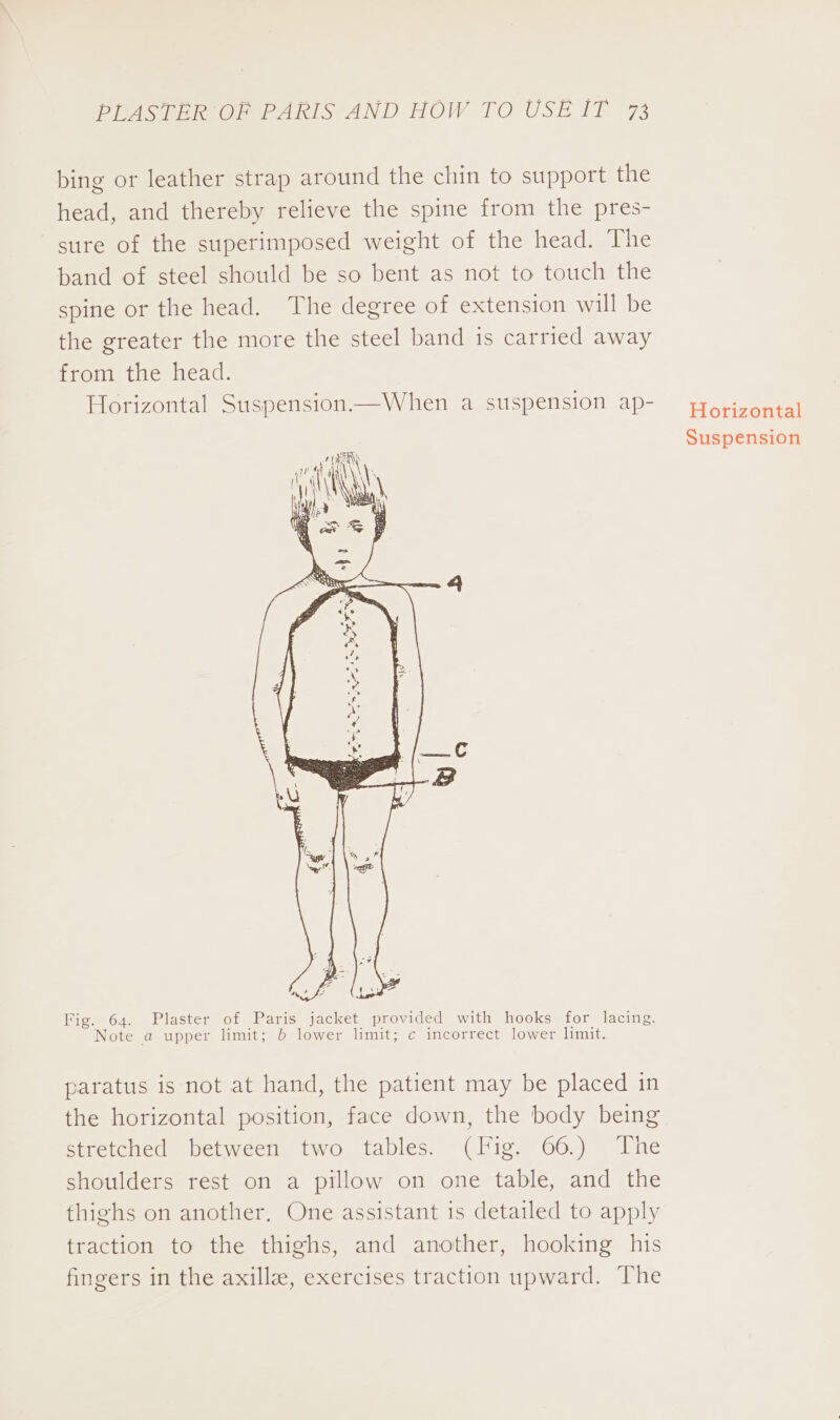 bing or leather strap around the chin to support the head, and thereby relieve the spine from the pres- sure of the superimposed weight of the head. The band of steel should be so bent as not to touch the spine or the head. The degree of extension will be the greater the more the steel band is carried away from the head. Horizontal Suspension.—When a suspension ap- ees AL x Fig. 64. Plaster of Paris jacket provided with hooks for lacing. Note a upper limit; b lower limit; c incorrect lower limit. paratus is not at hand, the patient may be placed in the horizontal position, face down, the body being stretched between two tables. (Fig. 66.) The shoulders rest on a pillow on one table, and the thighs on another, One assistant is detailed to apply traction to the thighs, and another, hooking his fingers in the axilla, exercises traction upward. The Horizontal Suspension