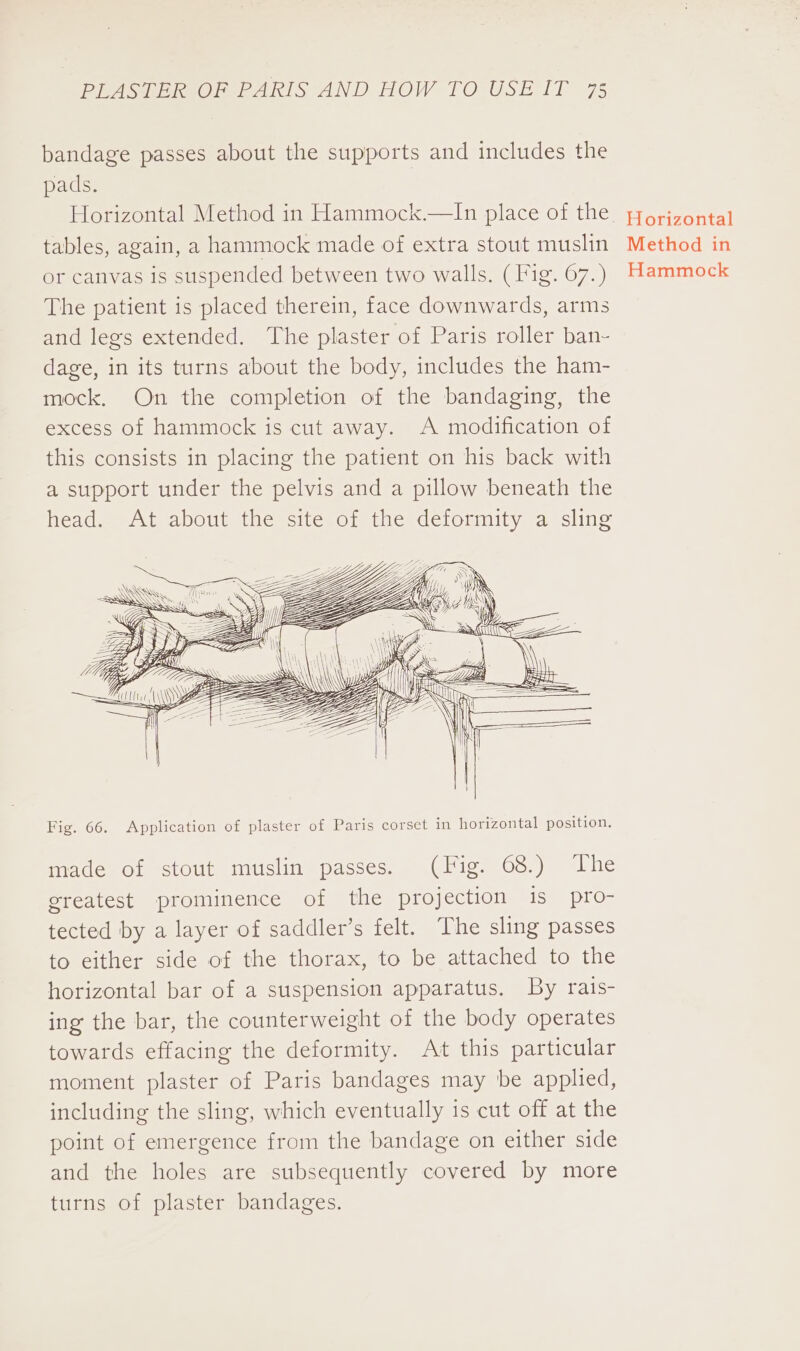 bandage passes about the supports and includes the pads. Horizontal Method in Hammock.—In place of the tables, again, a hammock made of extra stout muslin or canvas is suspended between two walls. (Fig. 67.) The patient is placed therein, face downwards, arms and legs extended. The plaster of Paris roller ban- dage, in its turns about the body, includes the ham- mock. On the completion of the bandaging, the excess of hammock is cut away. A modification of this consists in placing the patient on his back with a support under the pelvis and a pillow beneath the head. At about the site of the deformity a sling AN 7, SSS a (ZA SSSR Fig. 66. Application of plaster of Paris corset in horizontal position. made of stout muslin passes. (Fig. 68.) The greatest prominence of the projection is pro- tected by a layer of saddler’s felt. The sling passes to either side of the thorax, to be attached to the horizontal bar of a suspension apparatus. By rais- ing the bar, the counterweight of the body operates towards effacing the deformity. At this particular moment plaster of Paris bandages may be applied, including the sling, which eventually is cut off at the point of emergence from the bandage on either side and the holes are subsequently covered by more turns of plaster bandages. . Horizontal Method in Hammock