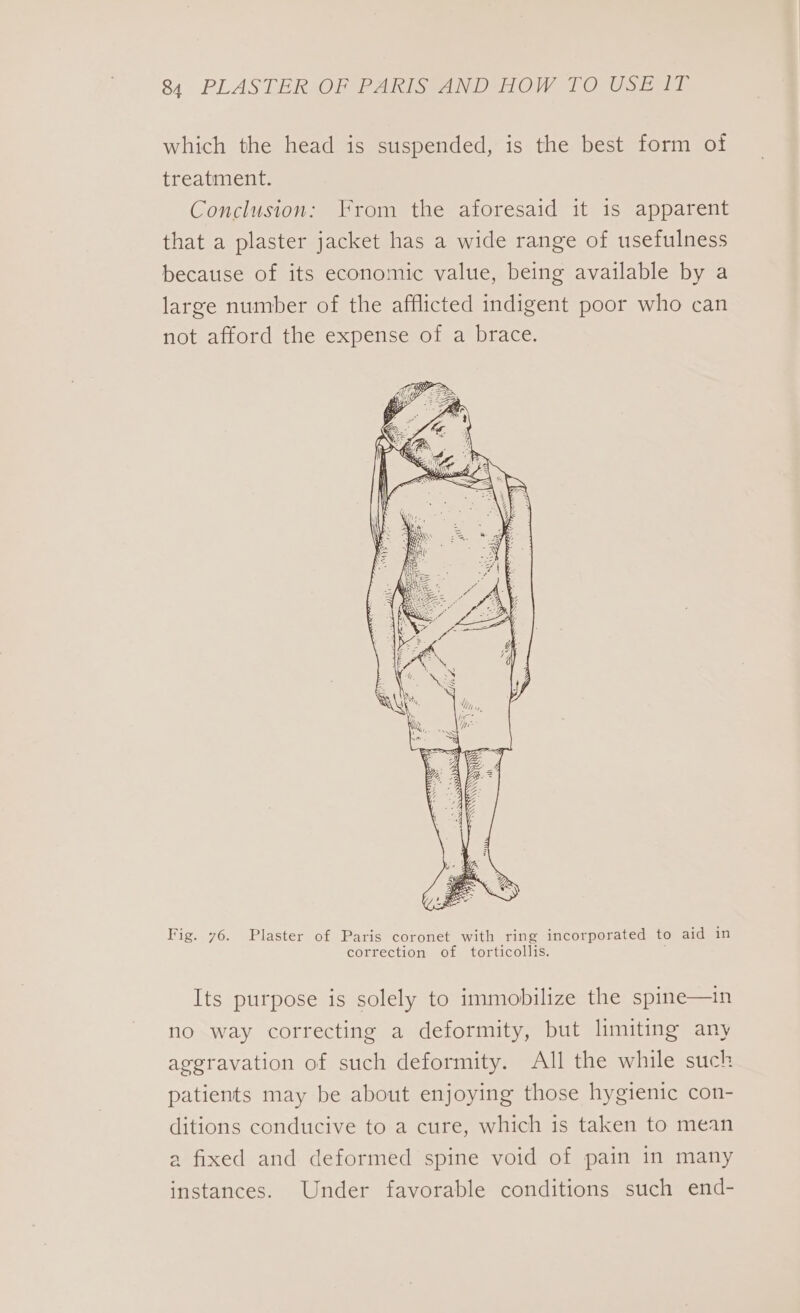 which the head is suspended, is the best form of treatment. Conclusion: From the aforesaid it is apparent that a plaster jacket has a wide range of usefulness because of its economic value, being available by a large number of the afflicted indigent poor who can not afford the expense of a brace. Fig. 76. Plaster of Paris coronet with ring incorporated to aid in correction of torticollis. Its purpose is solely to immobilize the spine—in no way correcting a deformity, but limiting any aggravation of such deformity. All the while such patients may be about enjoying those hygienic con- ditions conducive to a cure, which 1s taken to mean a fixed and deformed spine void of pain in many instances. Under favorable conditions such end-