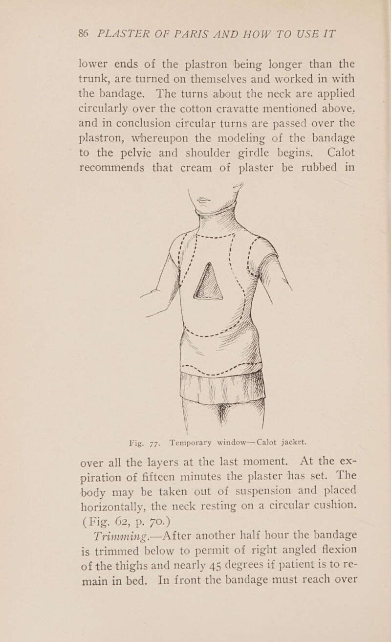 lower ends of the plastron being longer than the trunk, are turned on themselves and worked in with the bandage. The turns about the neck are applied circularly over the cotton cravatte mentioned above, and in conclusion circular turns are passed over the plastron, whereupon the modeling of the bandage ~ to the pelvic and shoulder girdle begins. Calot recommends that cream of plaster be rubbed in Fig. 77. Temporary window—Calot jacket. over all the layers at the last moment. At the ex- piration of fifteen minutes the plaster has set. The body may be taken out of suspension and placed horizontally, the neck resting on a circular cushion. CEig 362. p.070s) Trimming.—After another half hour the bandage is trimmed below to permit of right angled flexion of the thighs and nearly 45 degrees if patient is to re- main in bed. In front the bandage must reach over