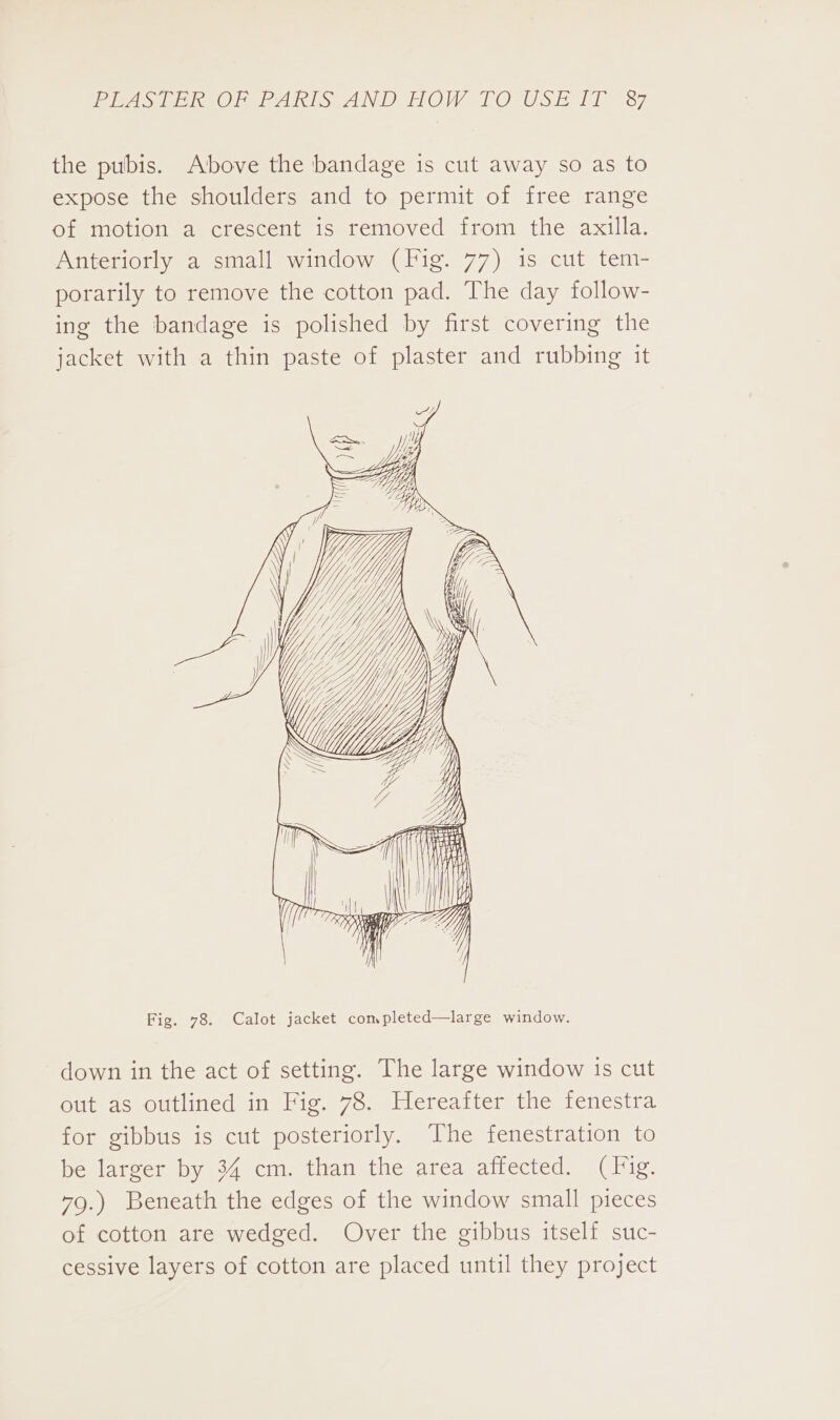 Pes bee eAnRIS AND HOW 1 O,USE Ii 37 the pubis. Above the bandage is cut away so as to expose the shoulders and to permit of free range of motion a crescent is removed from the axilla. Anteriorly a small window (Fig. 77) is cut tem- porarily to remove the cotton pad. The day follow- ing the bandage is polished by first covering the jacket with a thin paste of plaster and rubbing it | y Fig. 78. Calot jacket completed—large window. down in the act of setting. The large window is cut out as outlined in Fig. 78. Hereafter the fenestra for gibbus is cut posteriorly. The fenestration to be larger by 34 cm. than the area affected. (Fig. 79.) Beneath the edges of the window small pieces of cotton are wedged. Over the gibbus itself suc- cessive layers of cotton are placed until they project